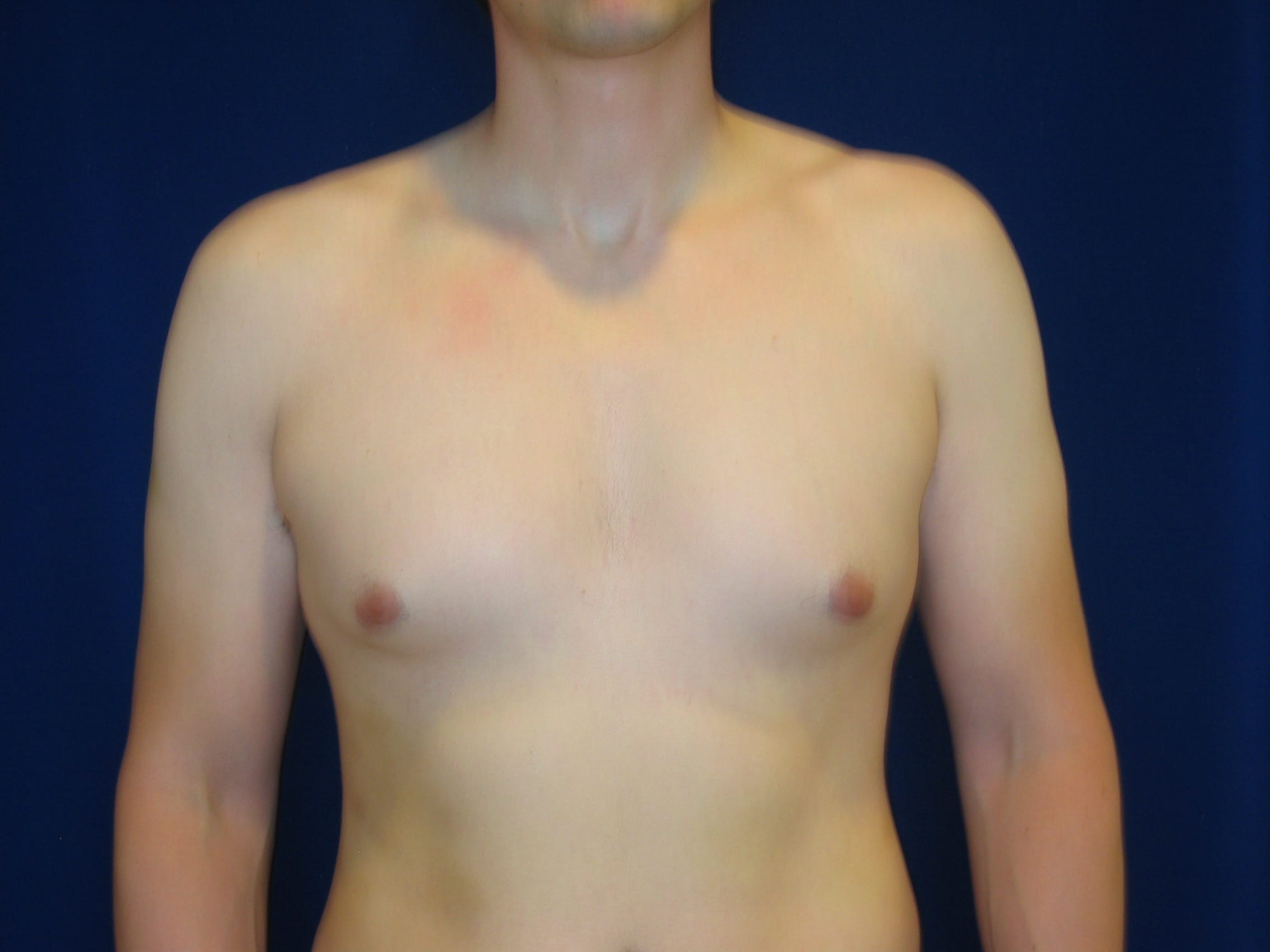 Gynecomastia Before and After | LV Plastic Surgery