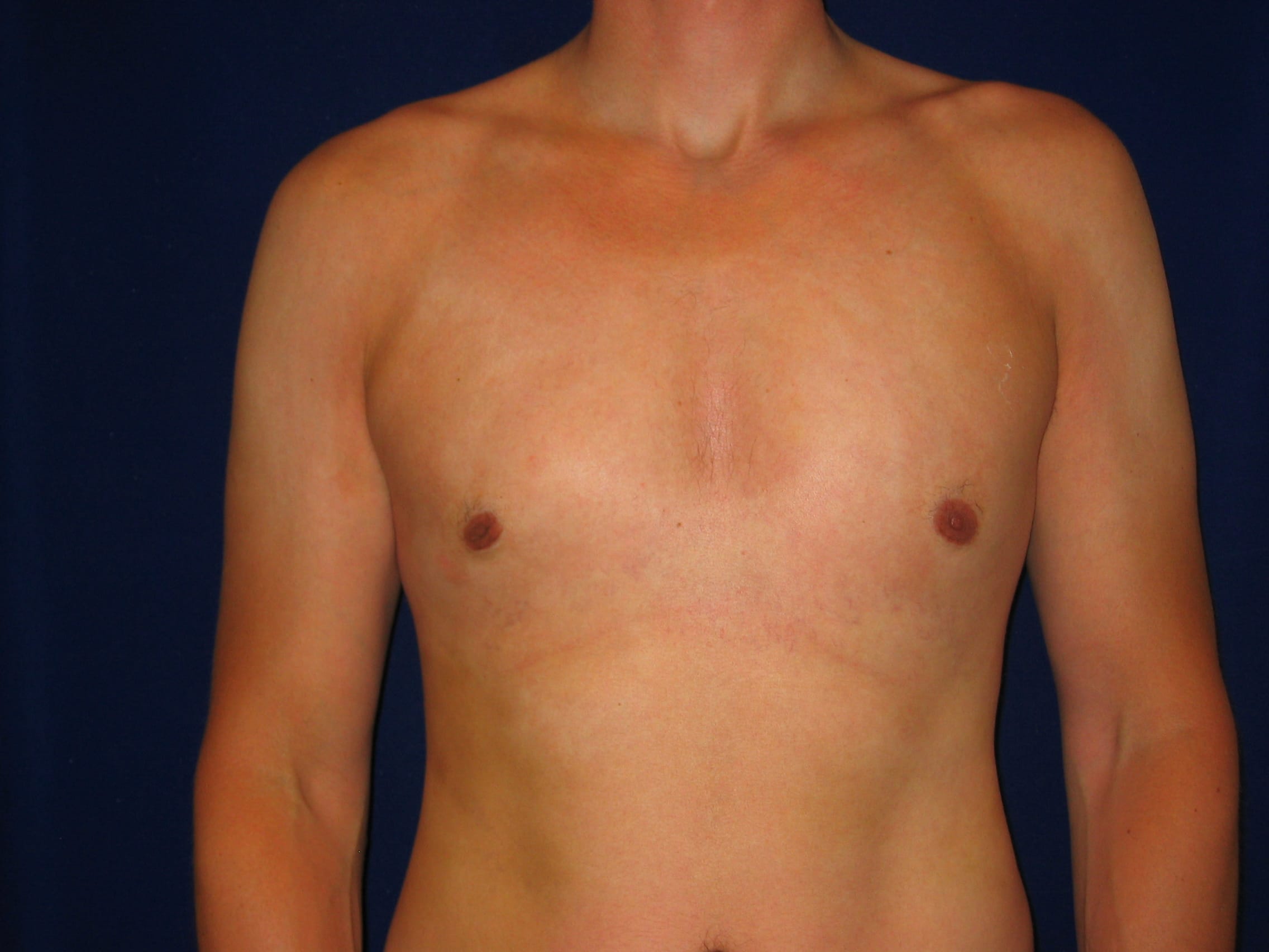 Gynecomastia Before and After | LV Plastic Surgery