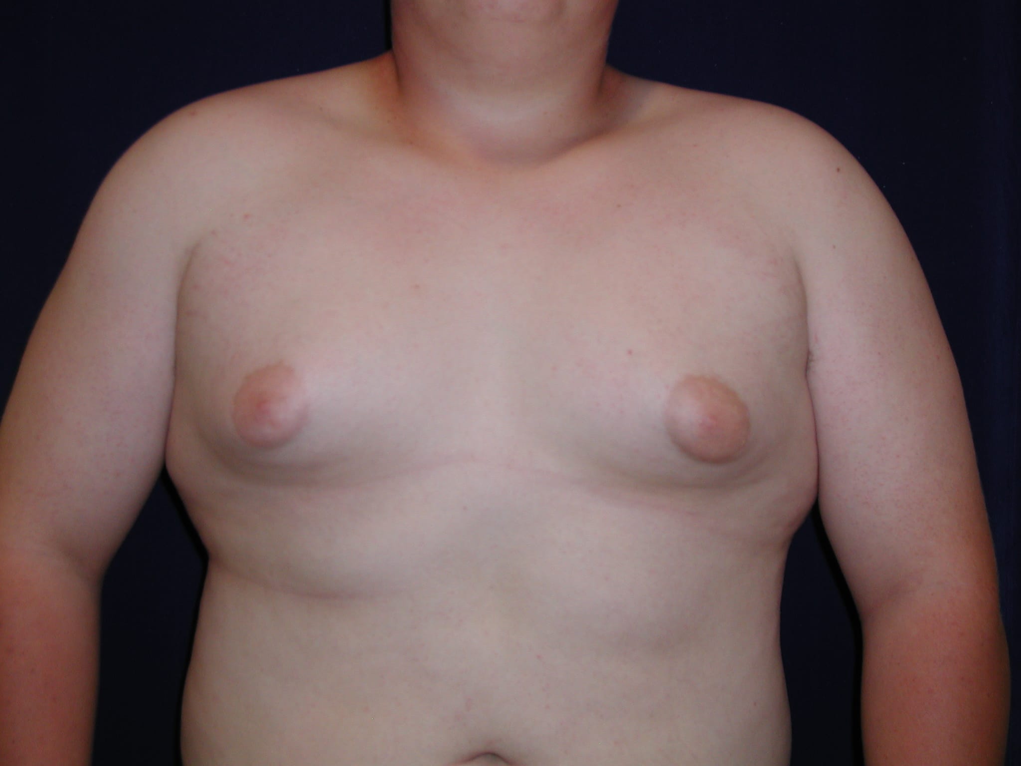 Gynecomastia Before and After | LV Plastic Surgery