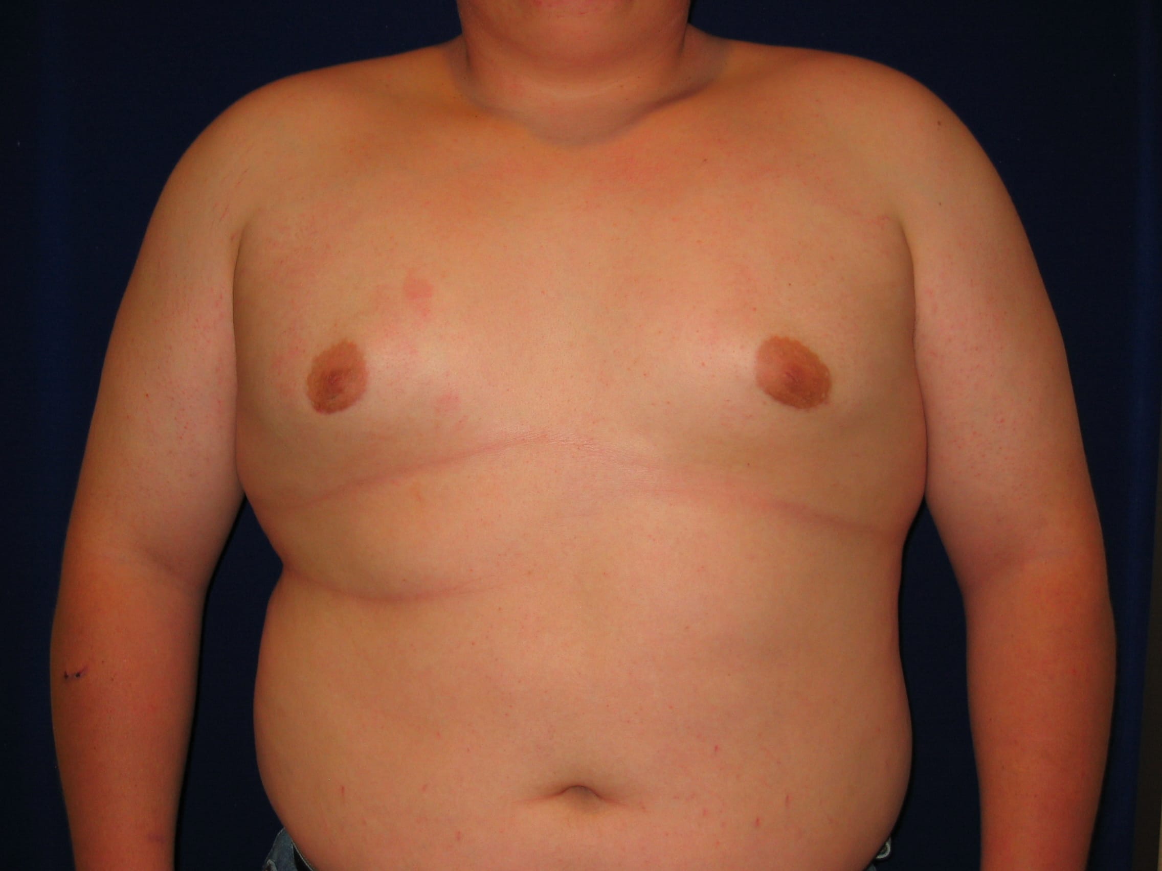 Gynecomastia Before and After | LV Plastic Surgery