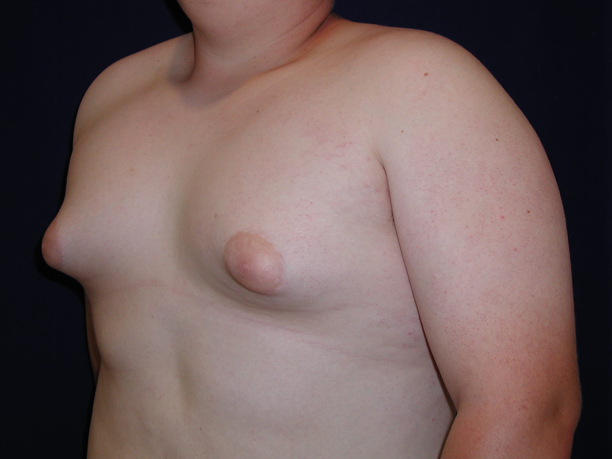 Gynecomastia Before and After | LV Plastic Surgery