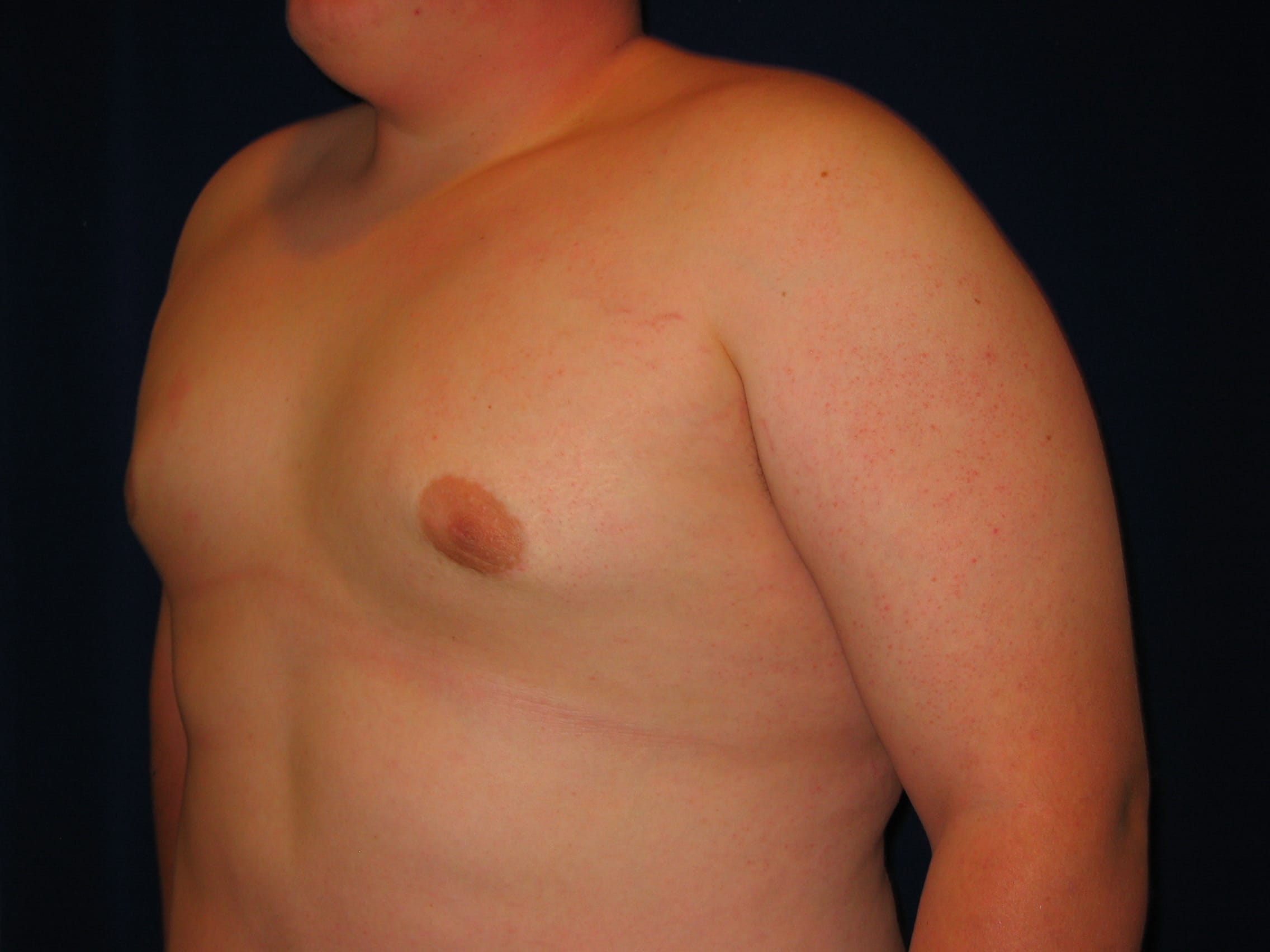 Gynecomastia Before and After | LV Plastic Surgery