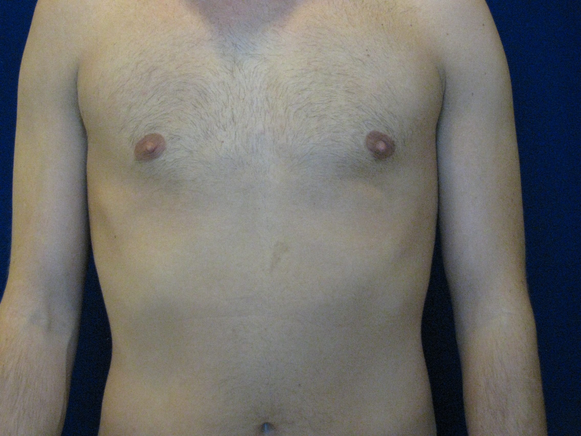 Gynecomastia Before and After | LV Plastic Surgery