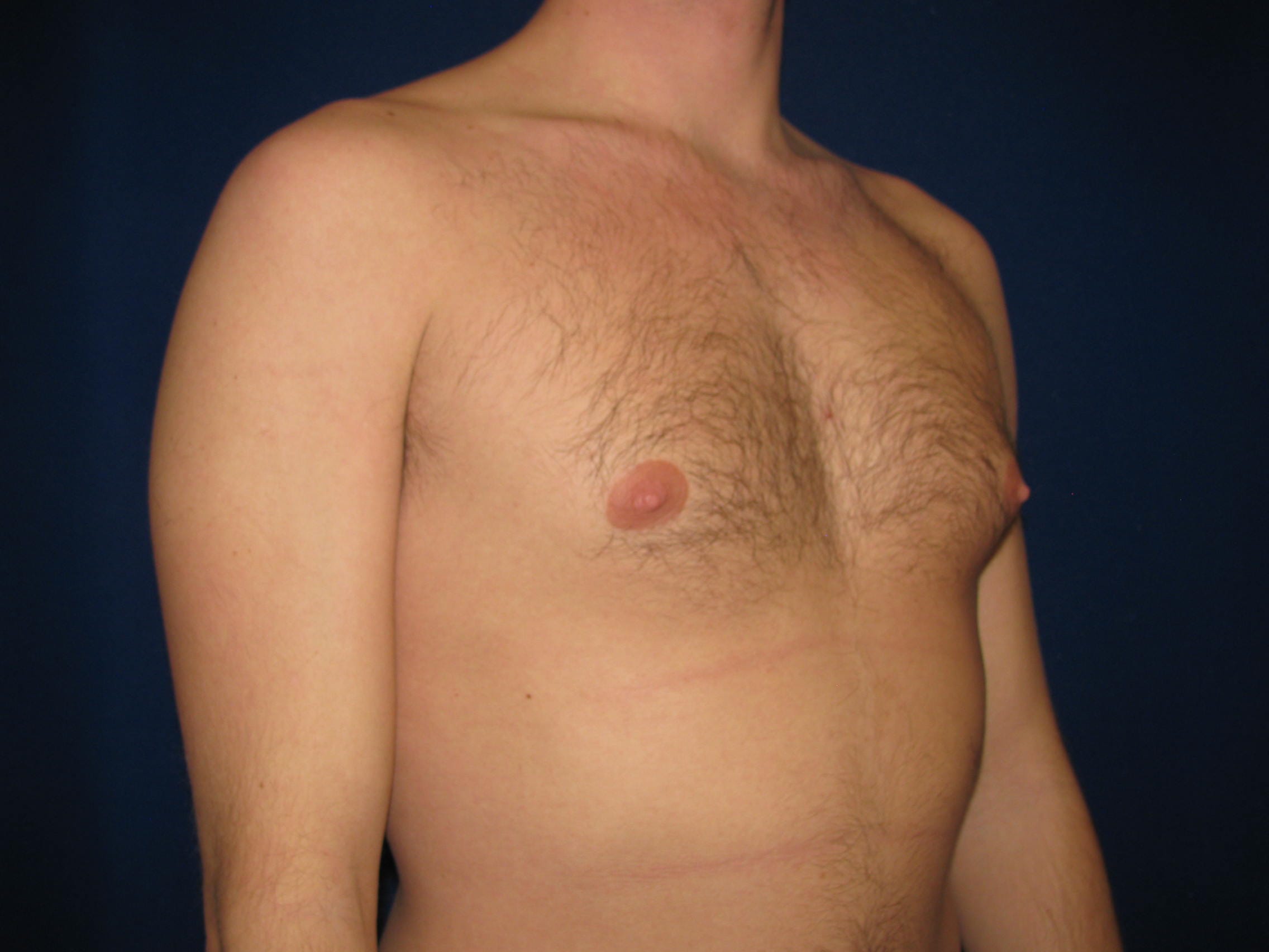 Gynecomastia Before and After | LV Plastic Surgery