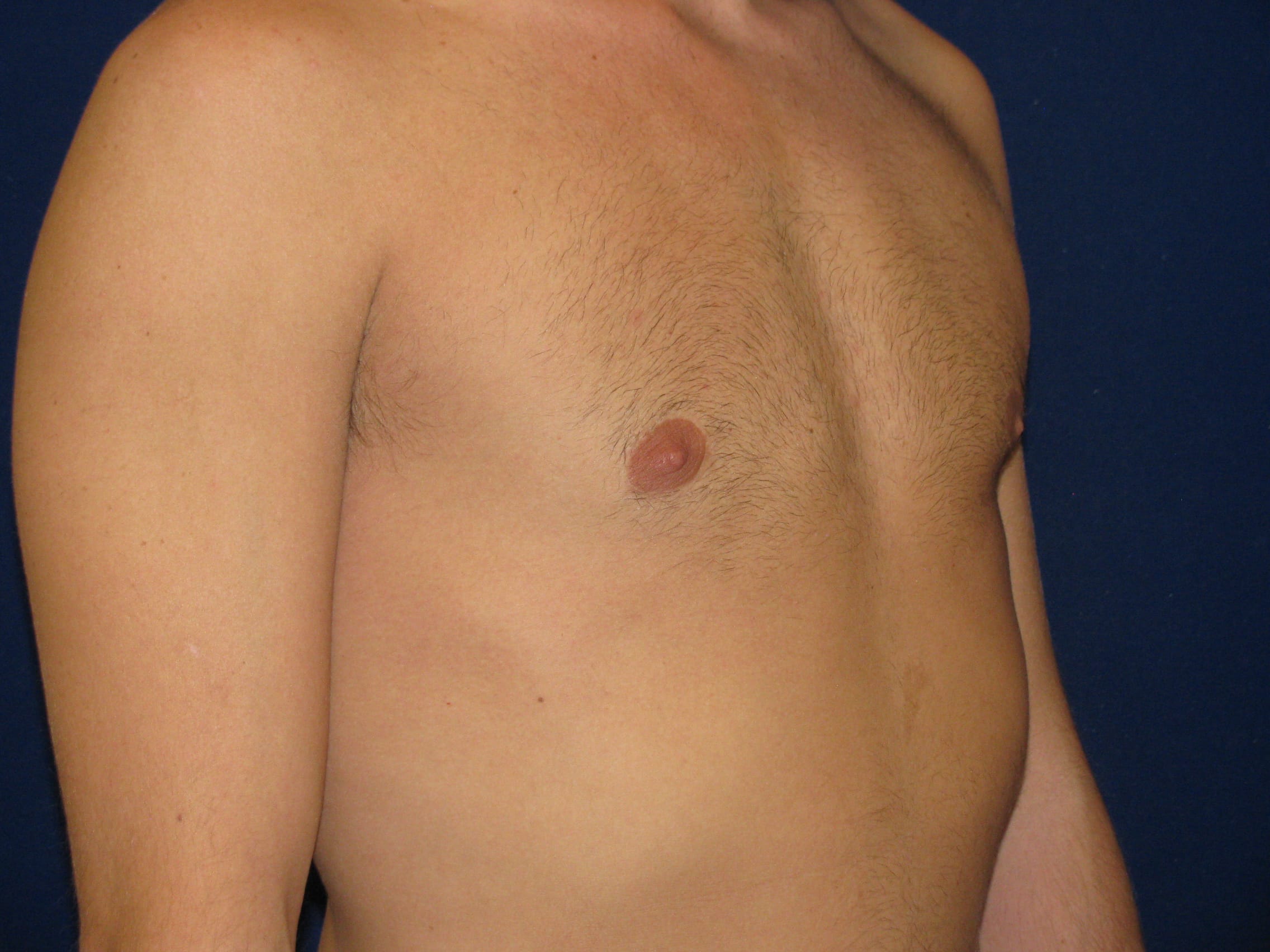 Gynecomastia Before and After | LV Plastic Surgery