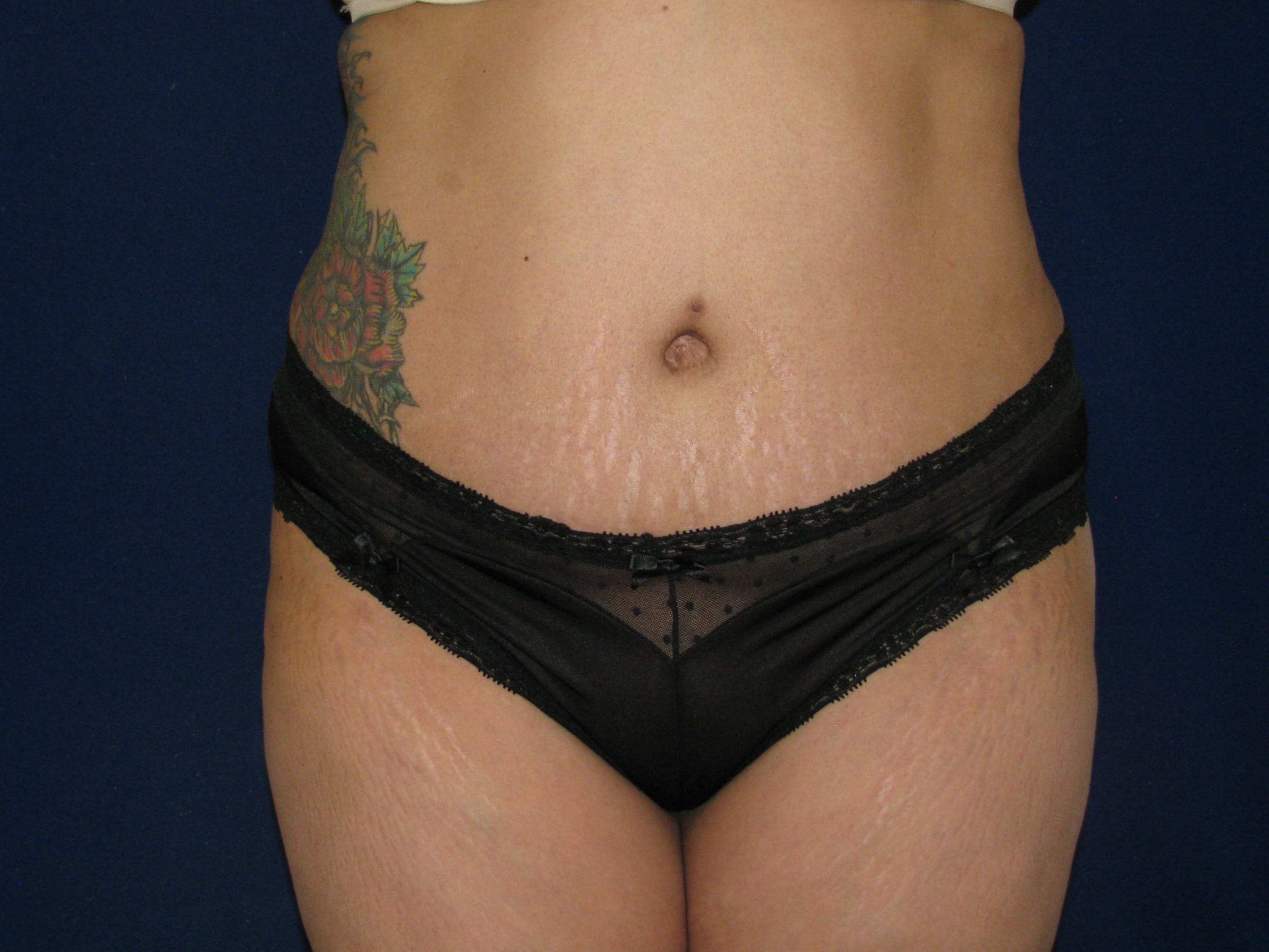 Liposuction Before and After | LV Plastic Surgery