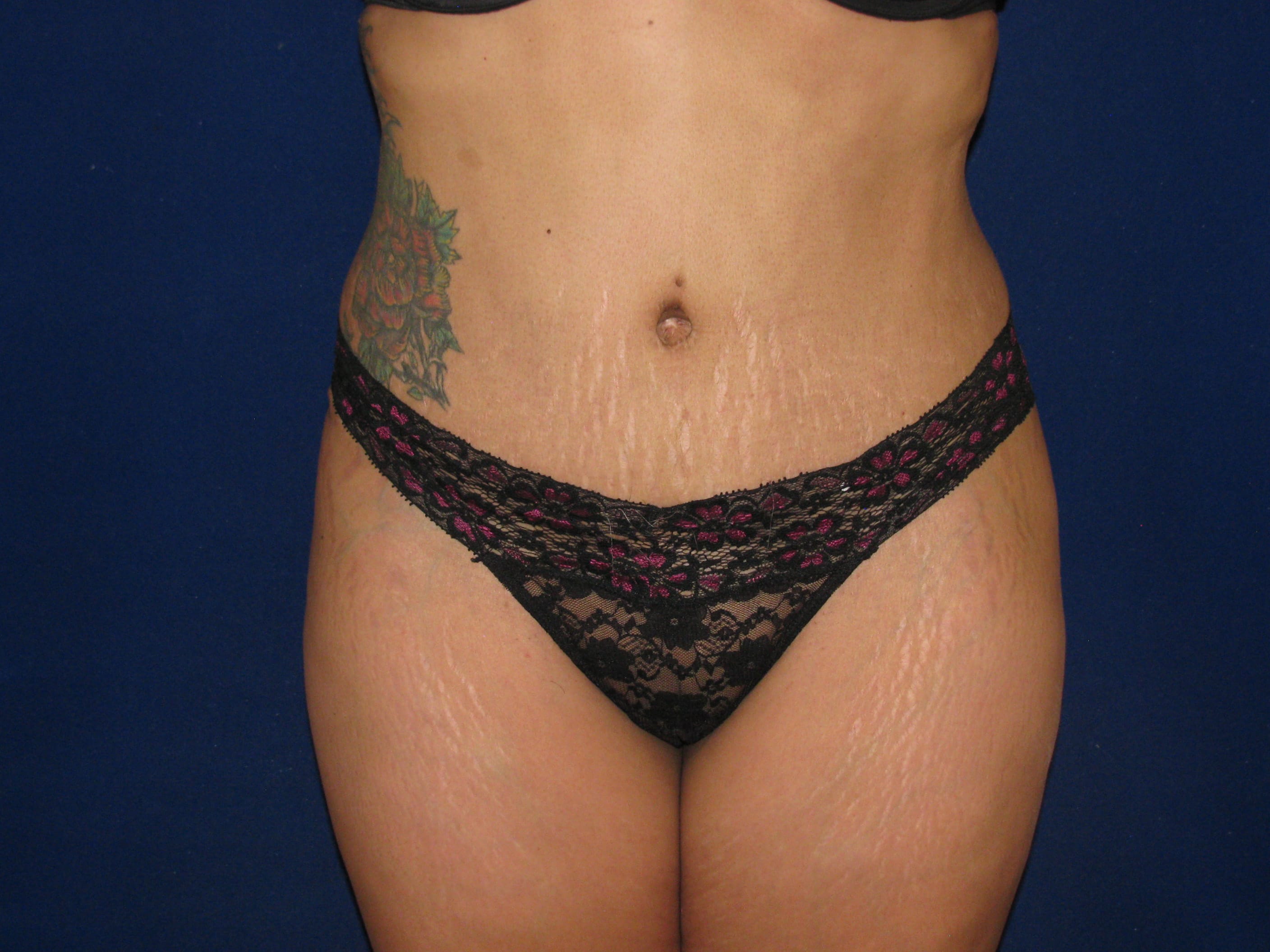 Liposuction Before and After | LV Plastic Surgery