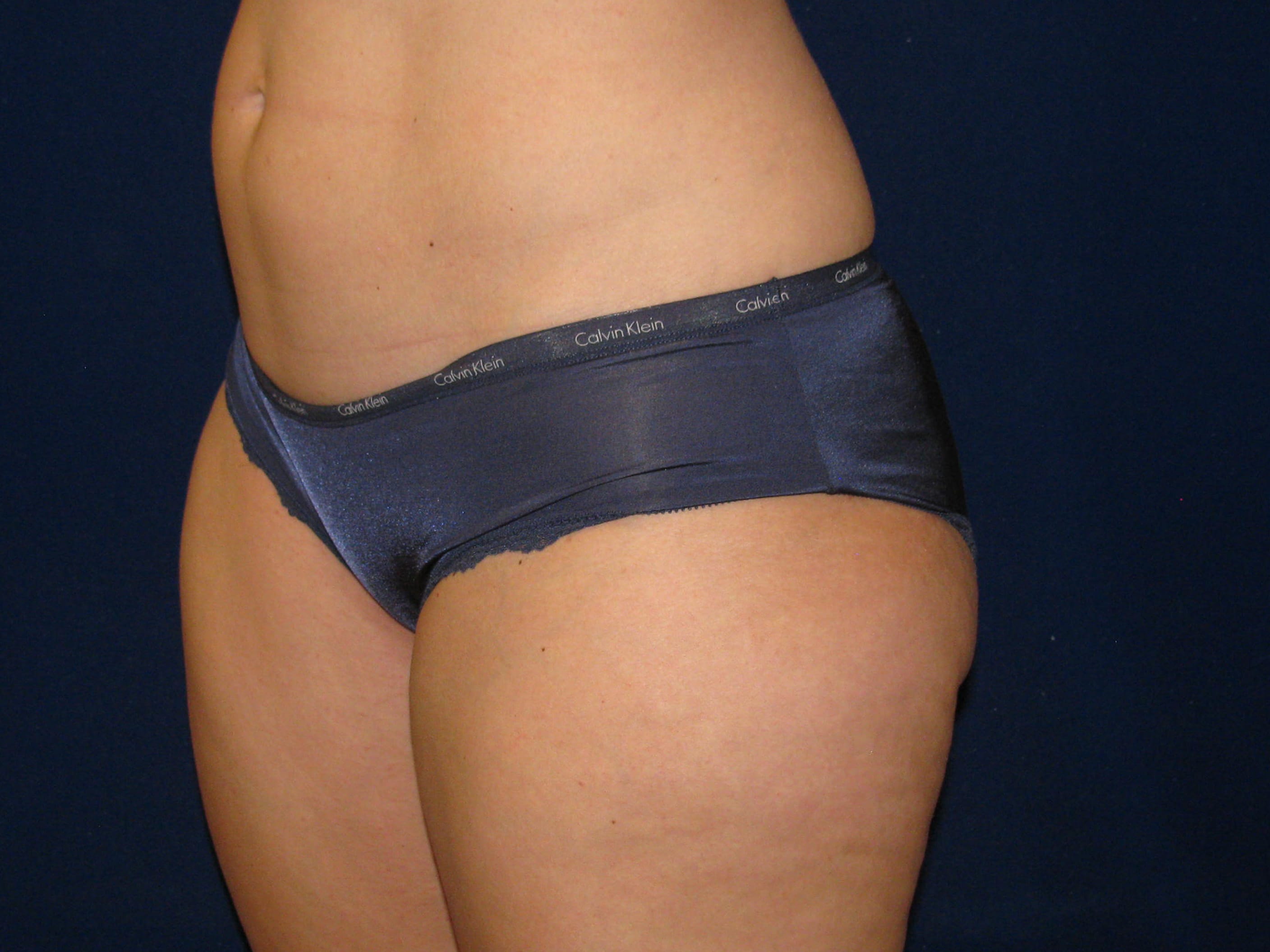 Liposuction Before and After | LV Plastic Surgery