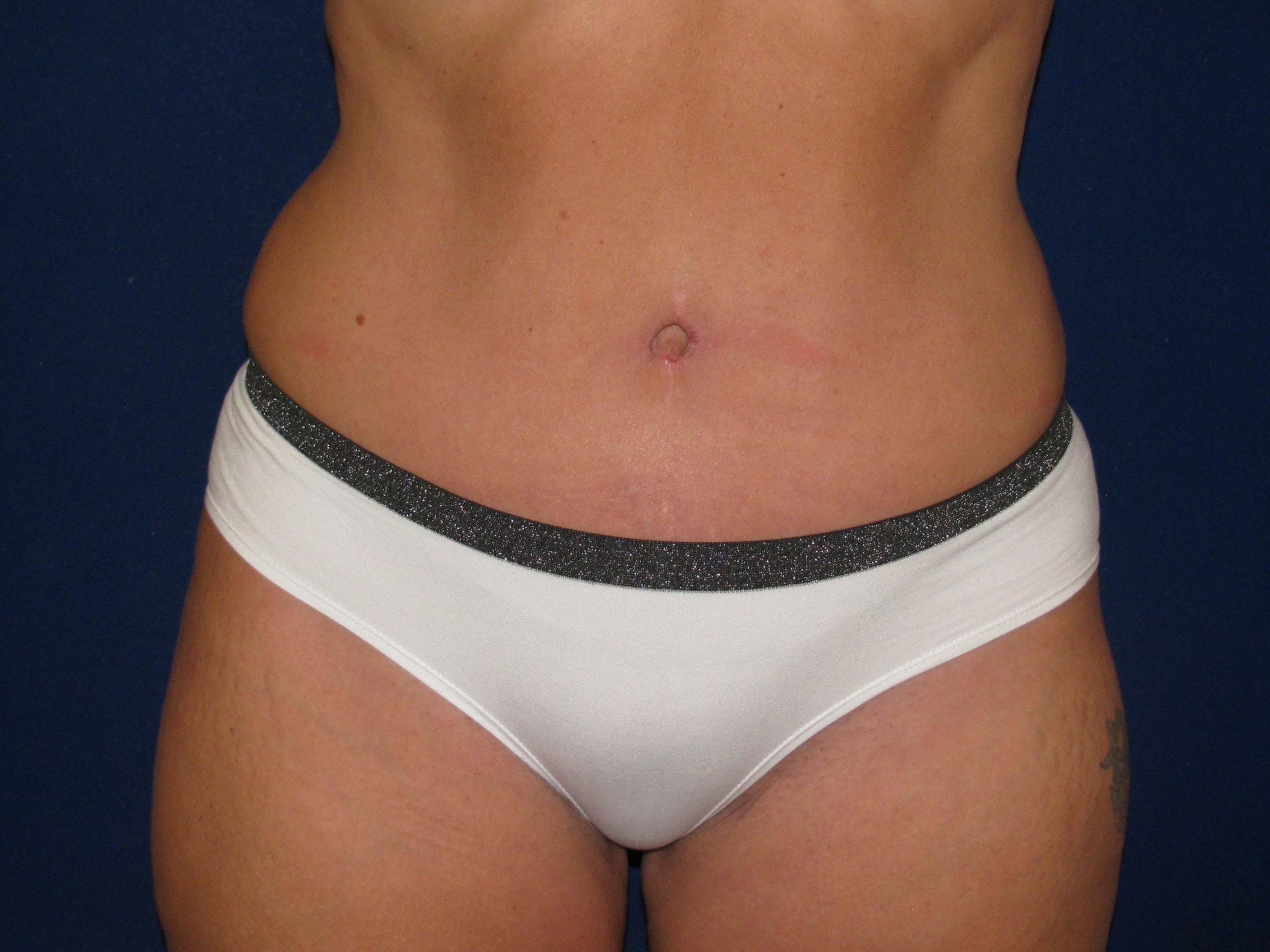 Liposuction Before and After | LV Plastic Surgery