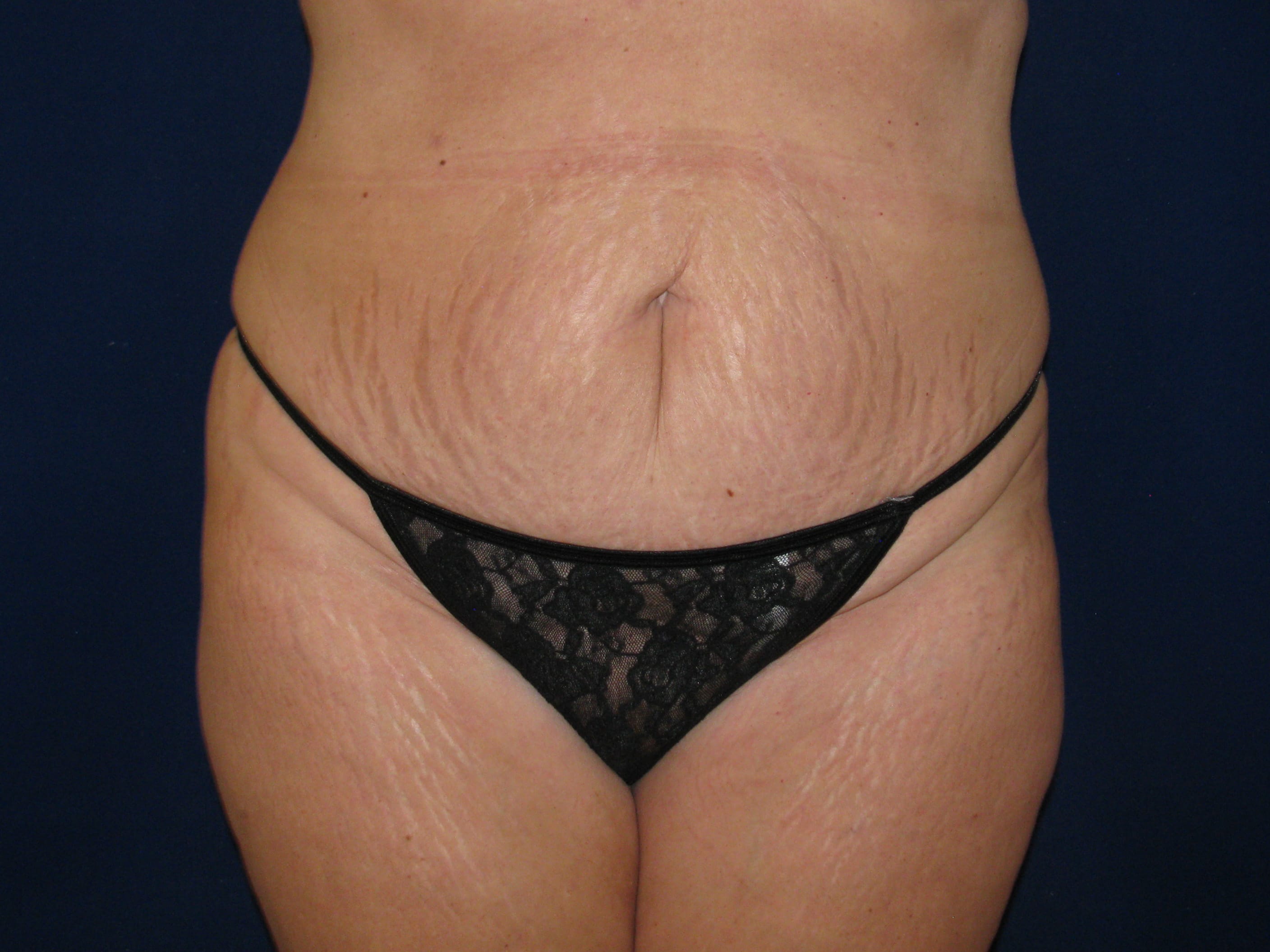 Liposuction Before and After | LV Plastic Surgery