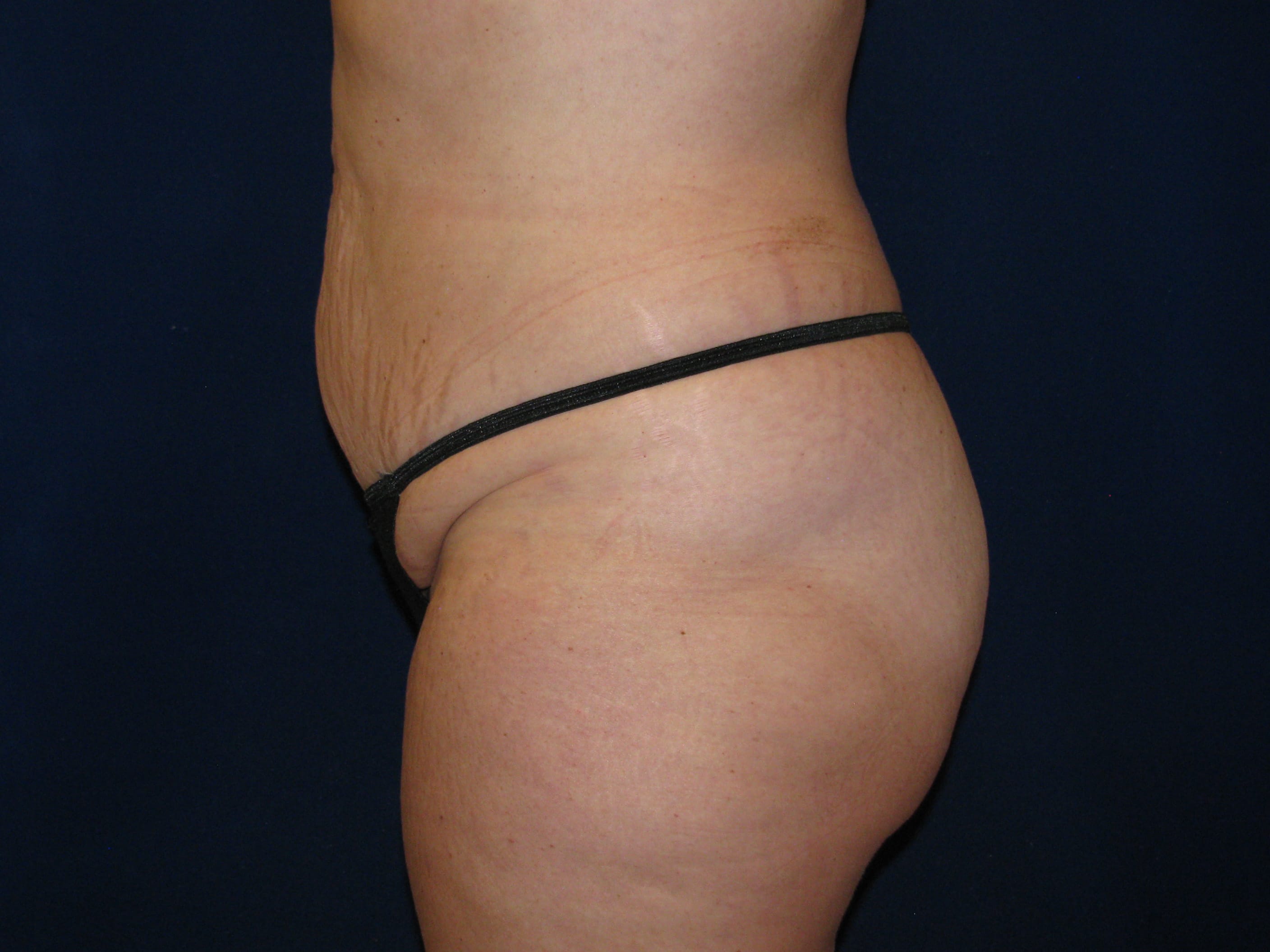 Liposuction Before and After | LV Plastic Surgery