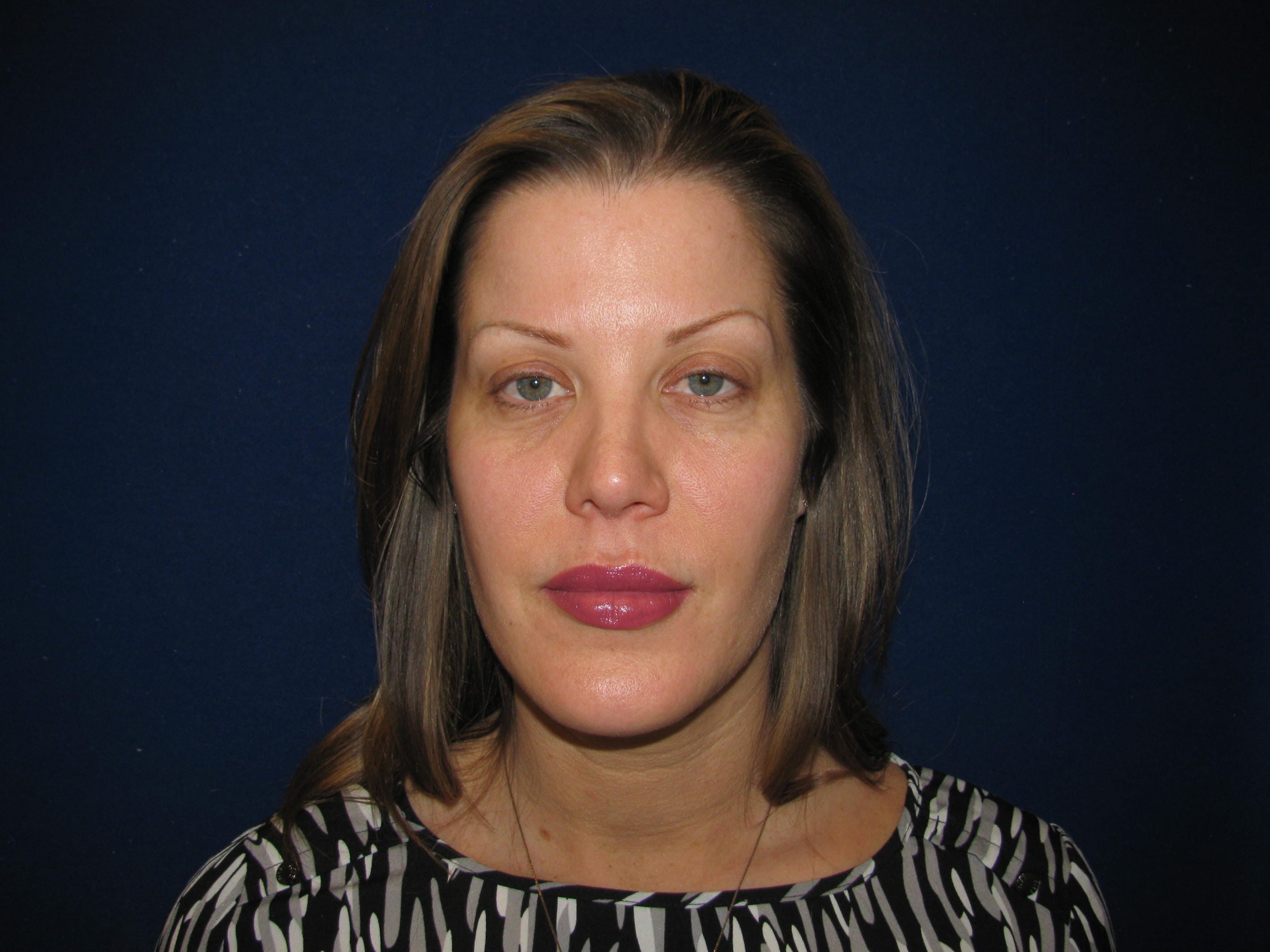 Lower Blepharoplasty Before and After | LV Plastic Surgery