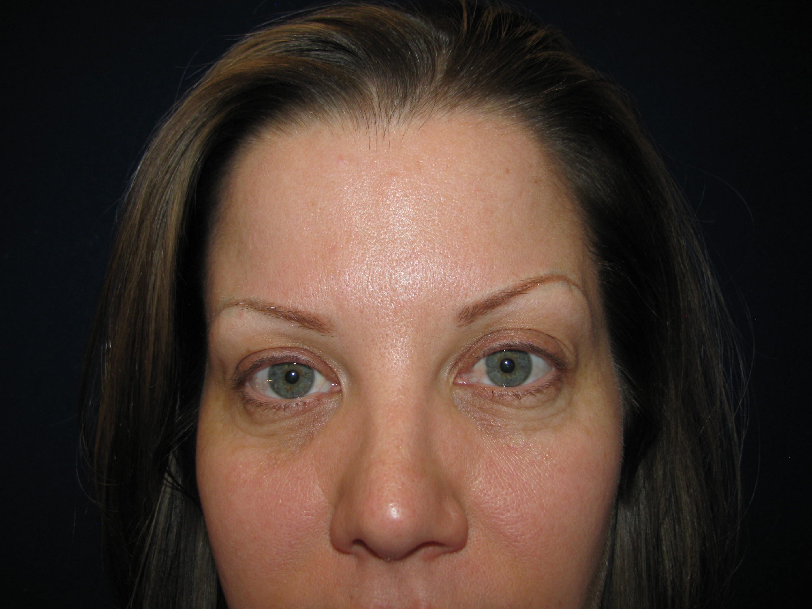 Lower Blepharoplasty Before and After | LV Plastic Surgery