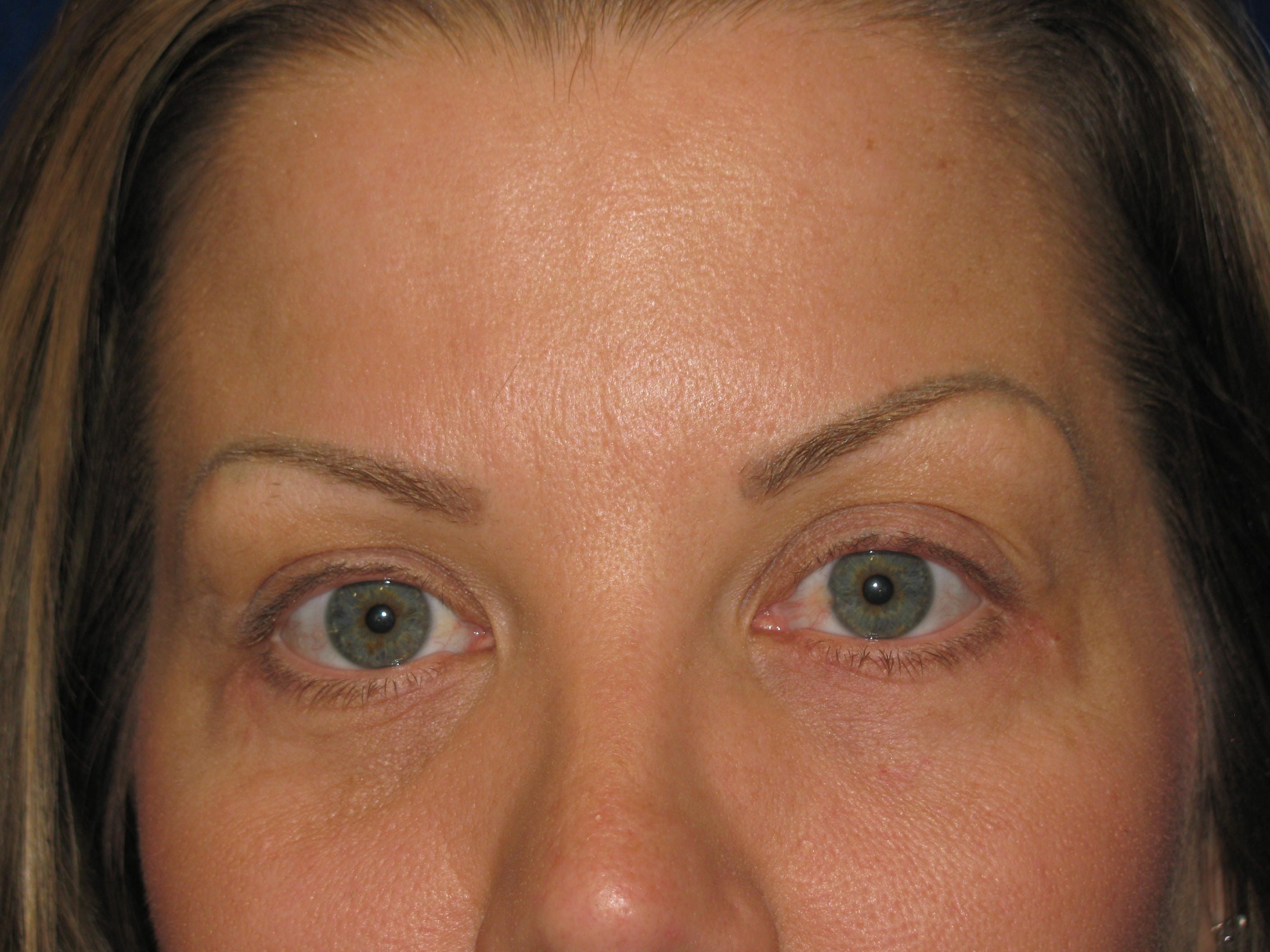 Lower Blepharoplasty Before and After | LV Plastic Surgery