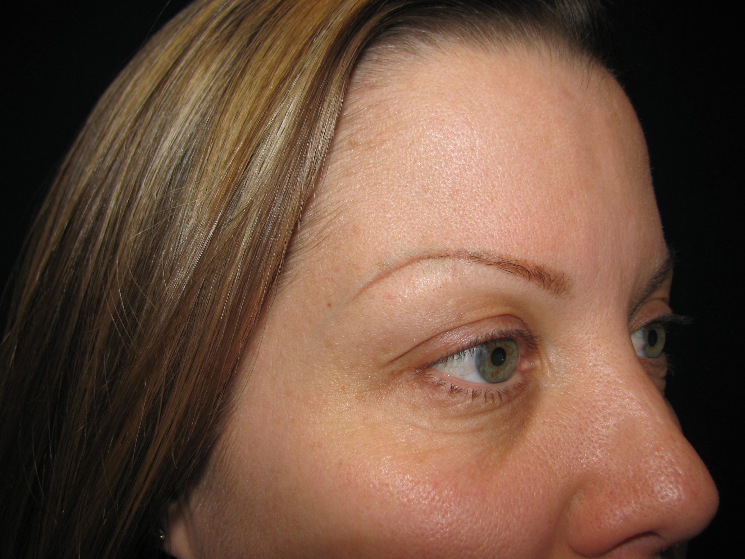 Lower Blepharoplasty Before and After | LV Plastic Surgery