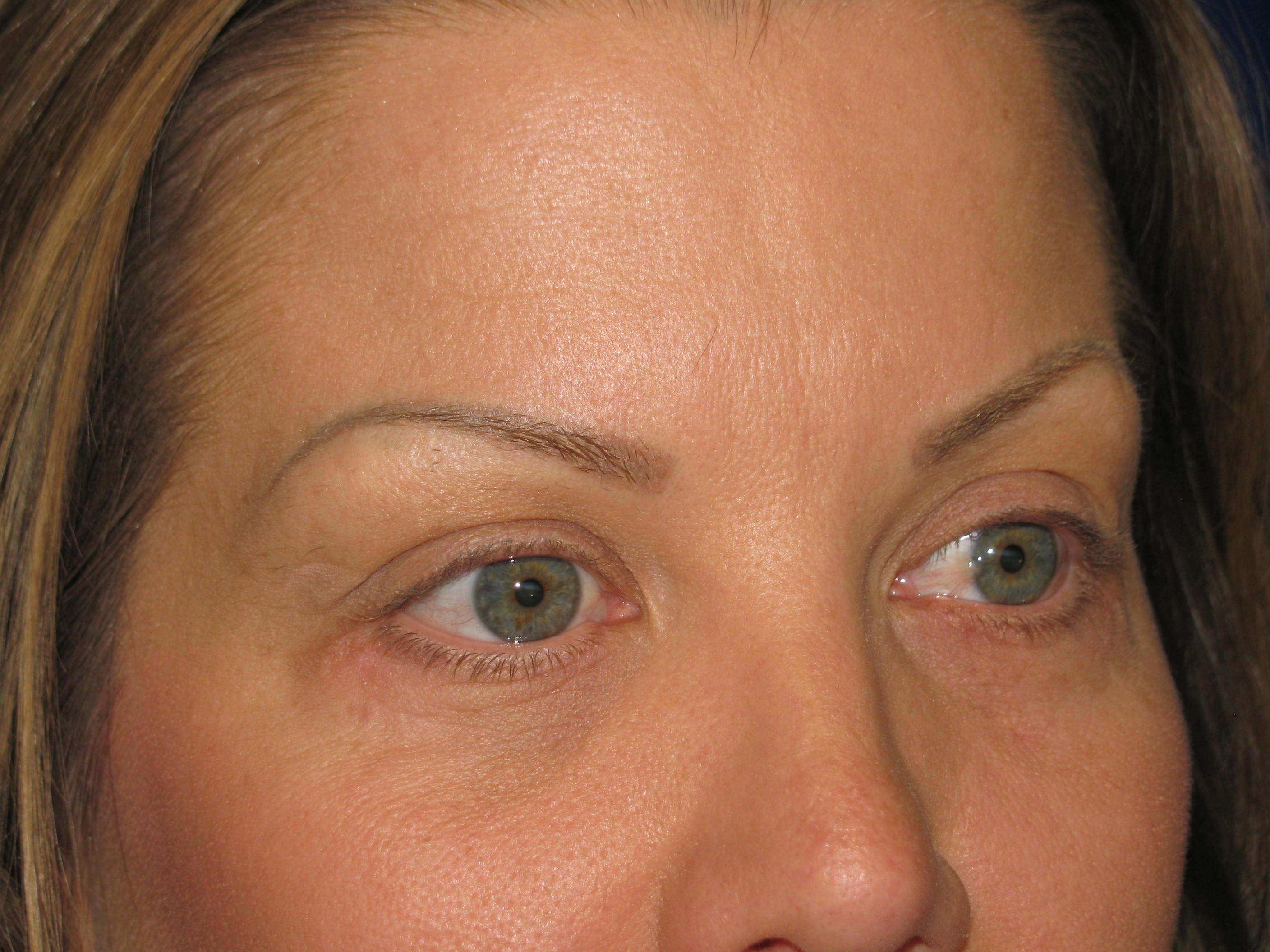 Lower Blepharoplasty Before and After | LV Plastic Surgery