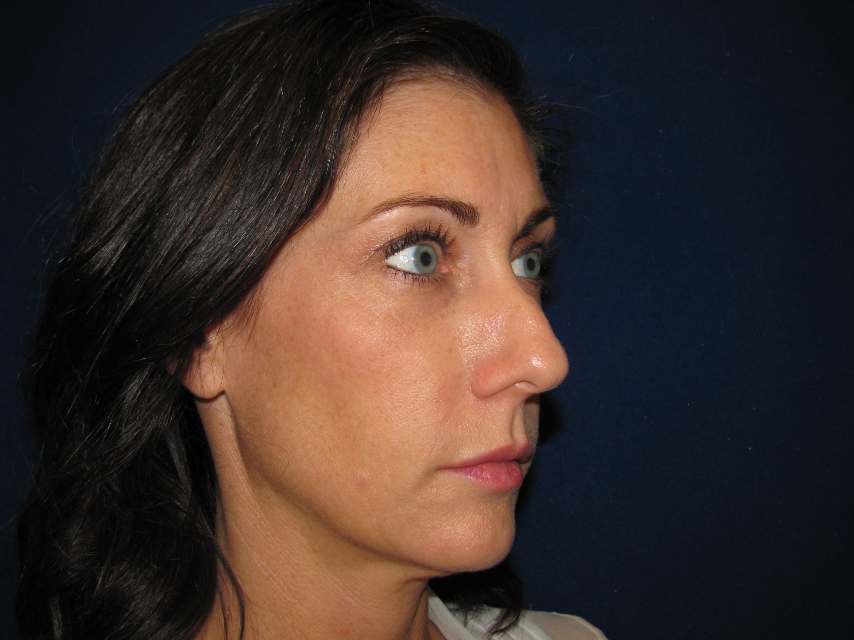 Rhinoplasty Before and After | LV Plastic Surgery