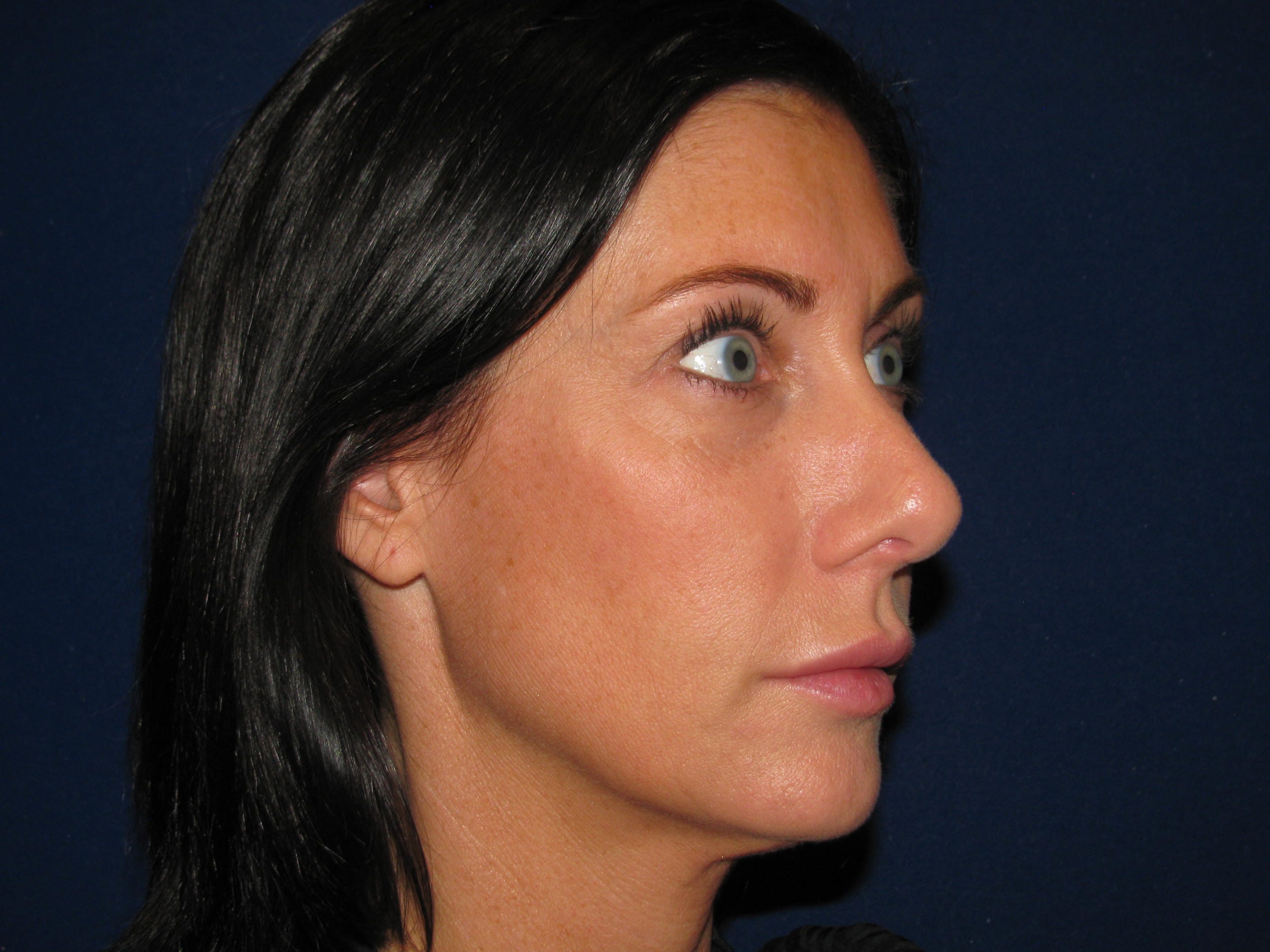 Rhinoplasty Before and After | LV Plastic Surgery