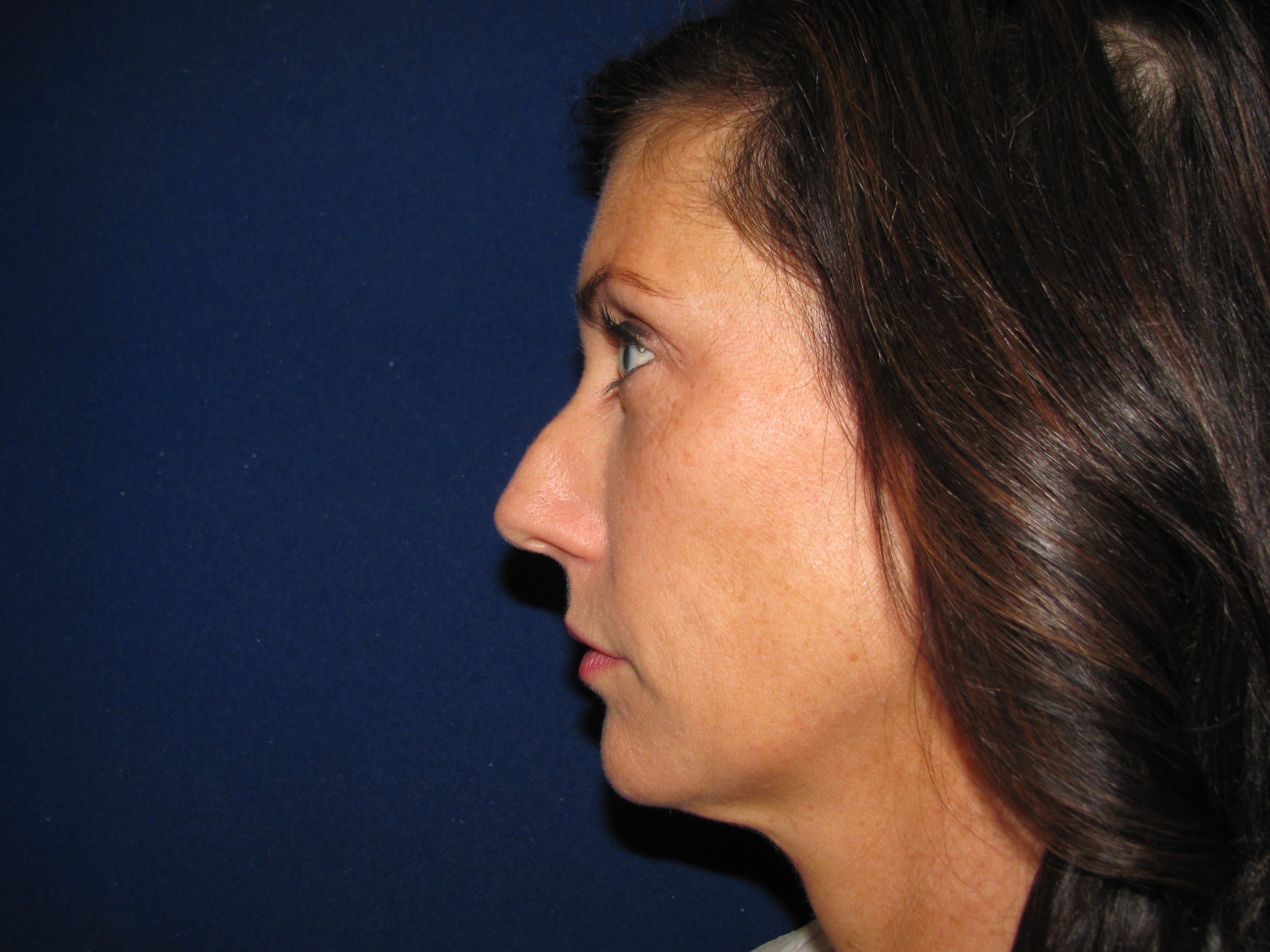 Rhinoplasty Before and After | LV Plastic Surgery