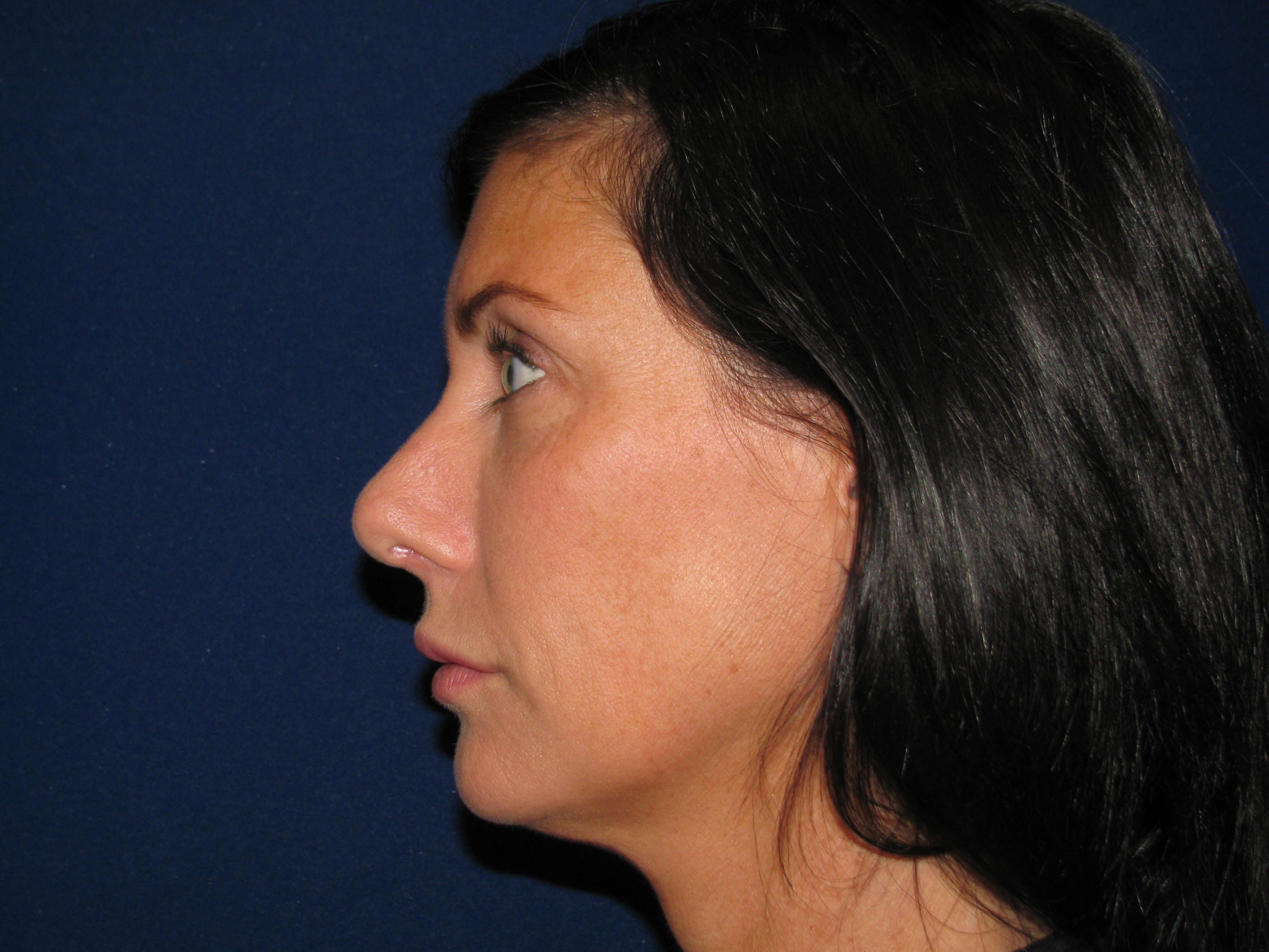 Rhinoplasty Before and After | LV Plastic Surgery