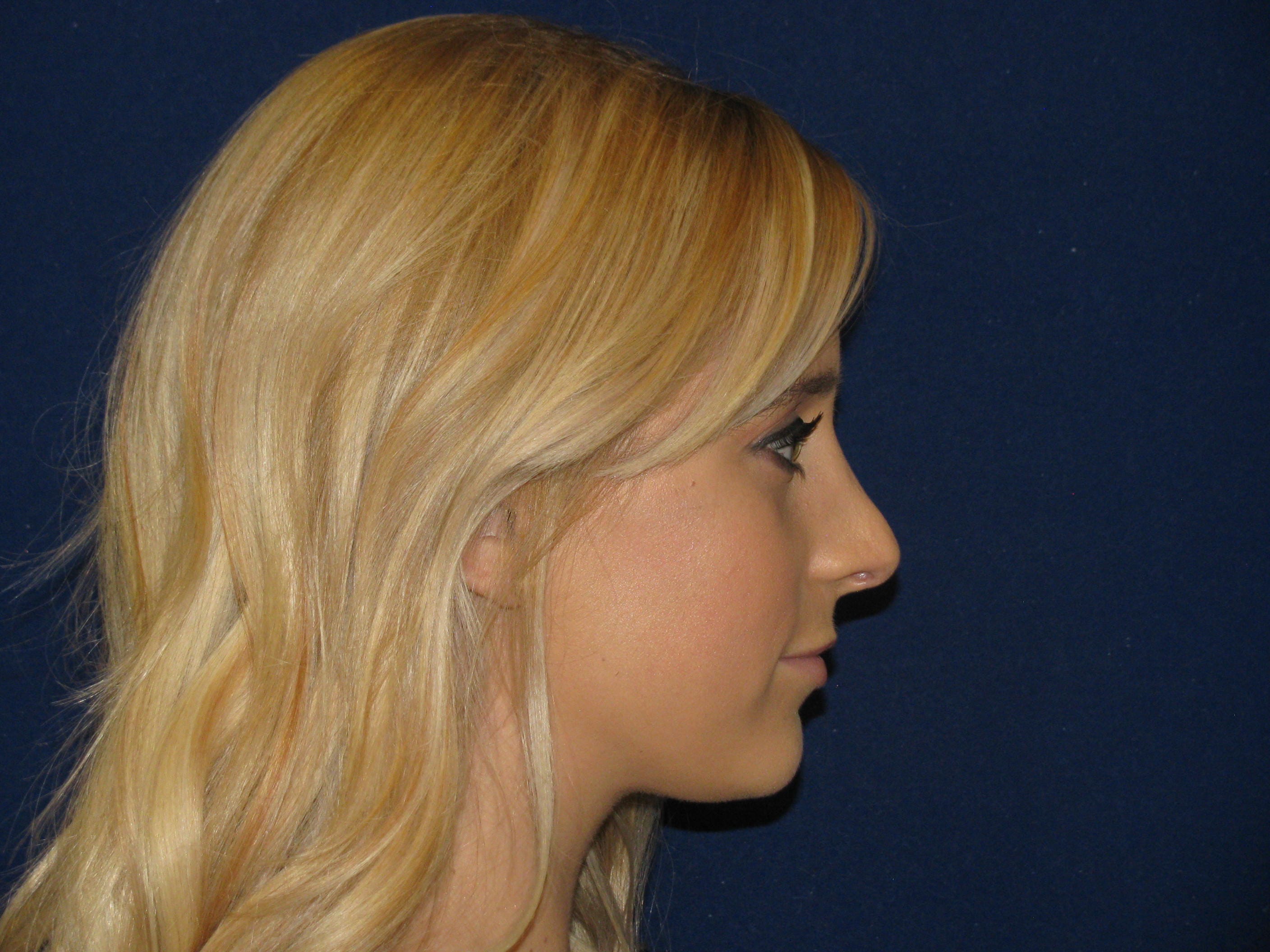 Rhinoplasty Before and After | LV Plastic Surgery