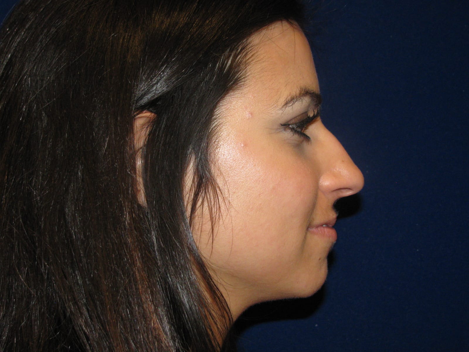 Rhinoplasty Before and After | LV Plastic Surgery