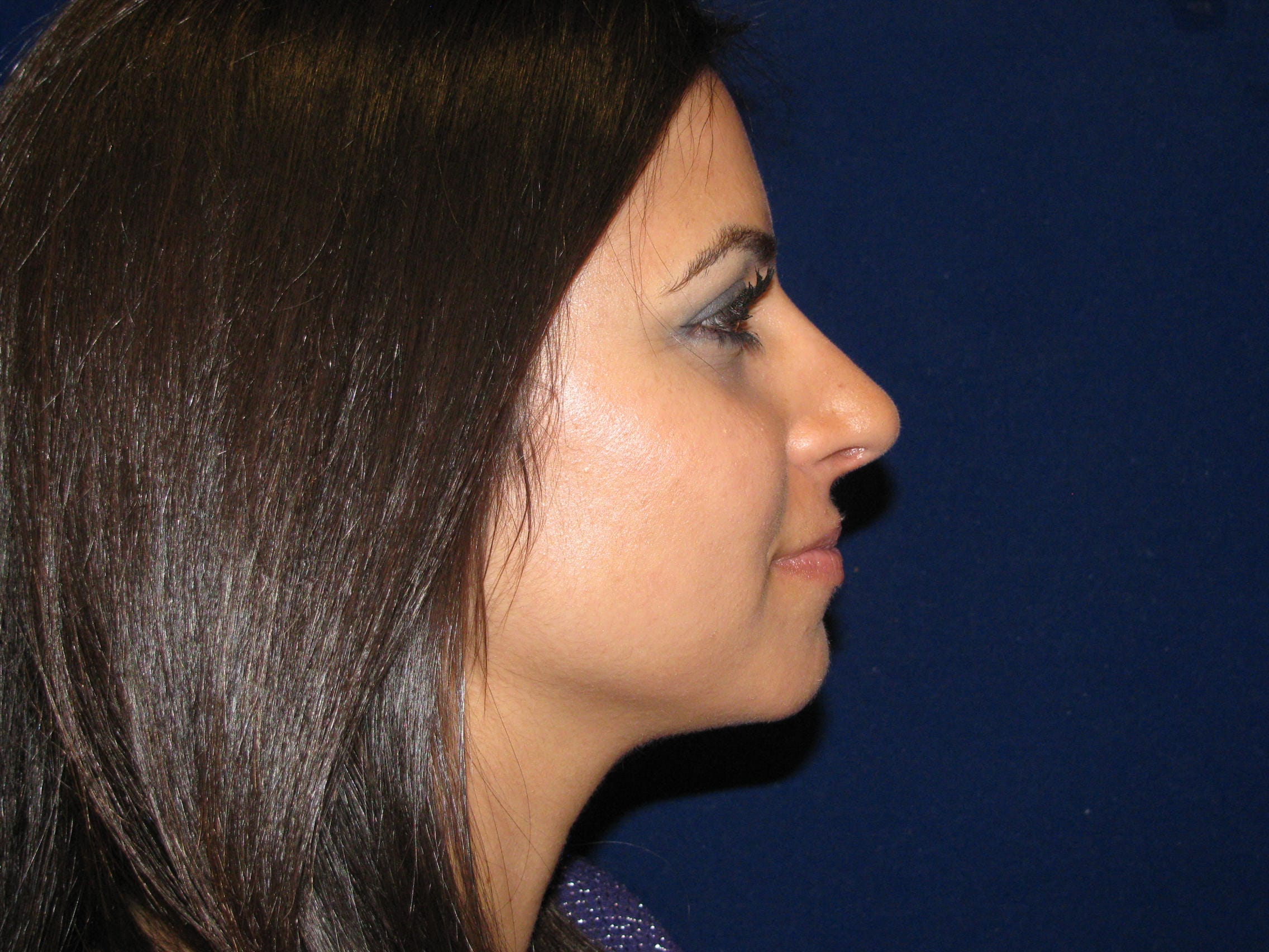 Rhinoplasty Before and After | LV Plastic Surgery