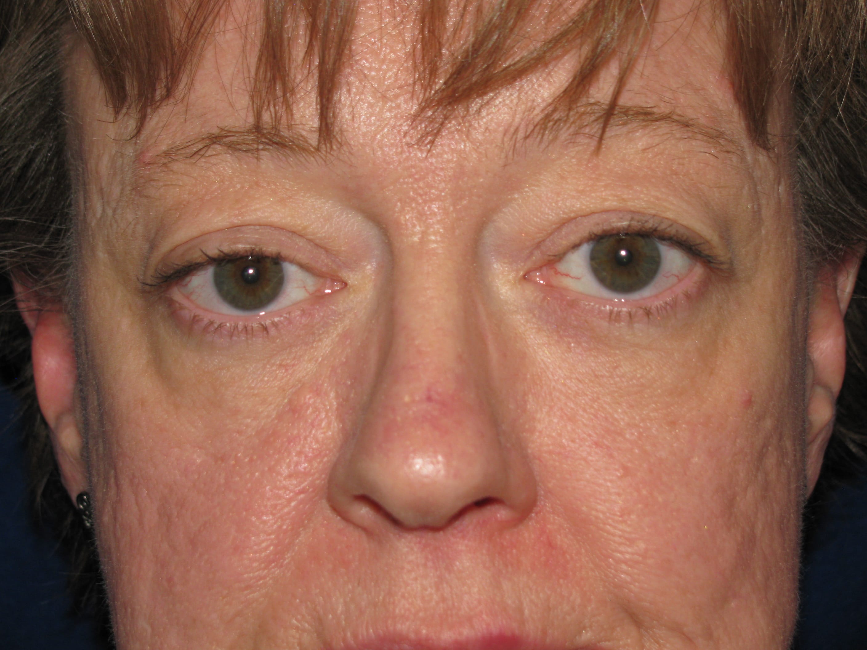 Upper Blepharoplasty Before and After | LV Plastic Surgery