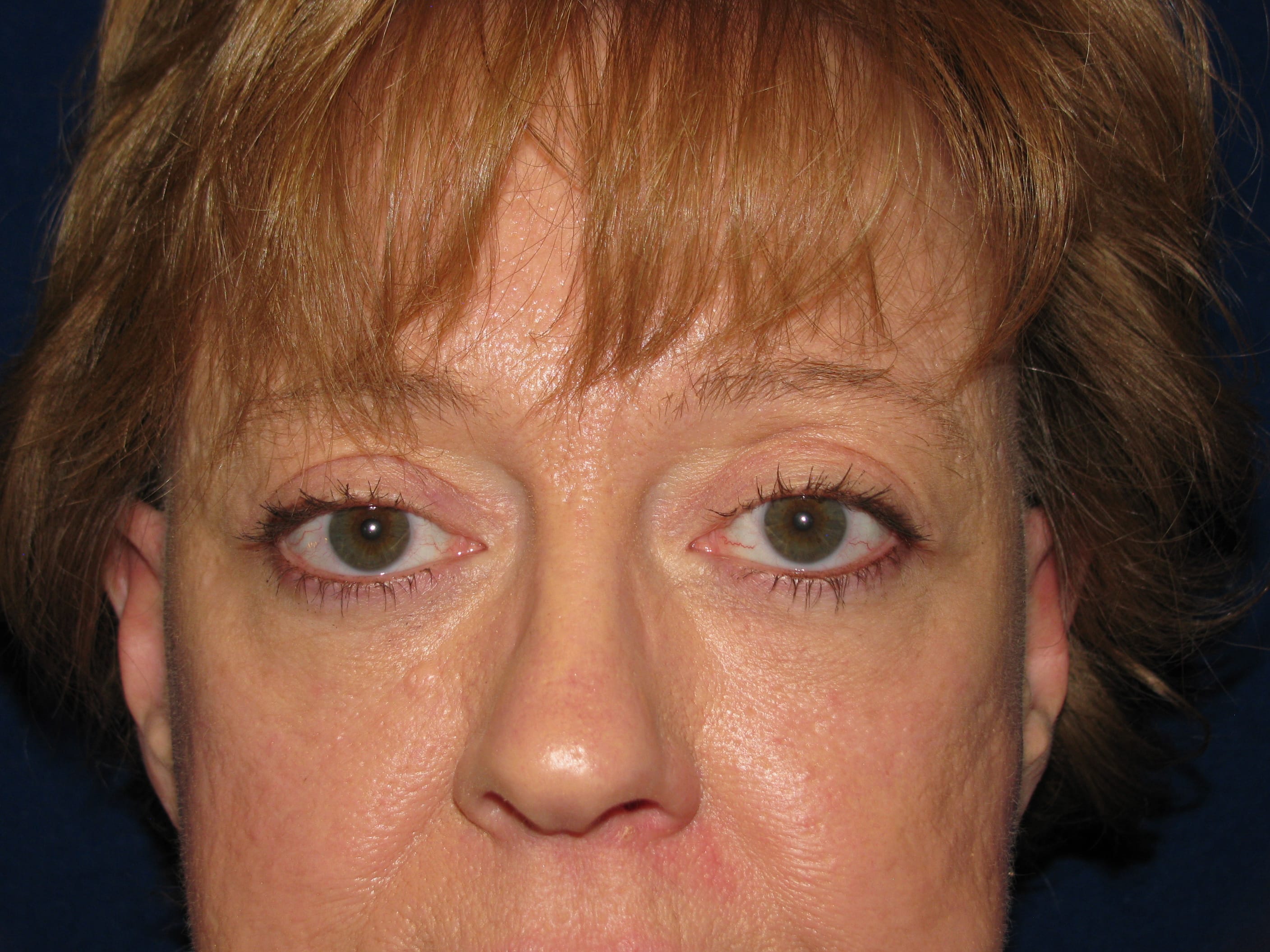 Upper Blepharoplasty Before and After | LV Plastic Surgery