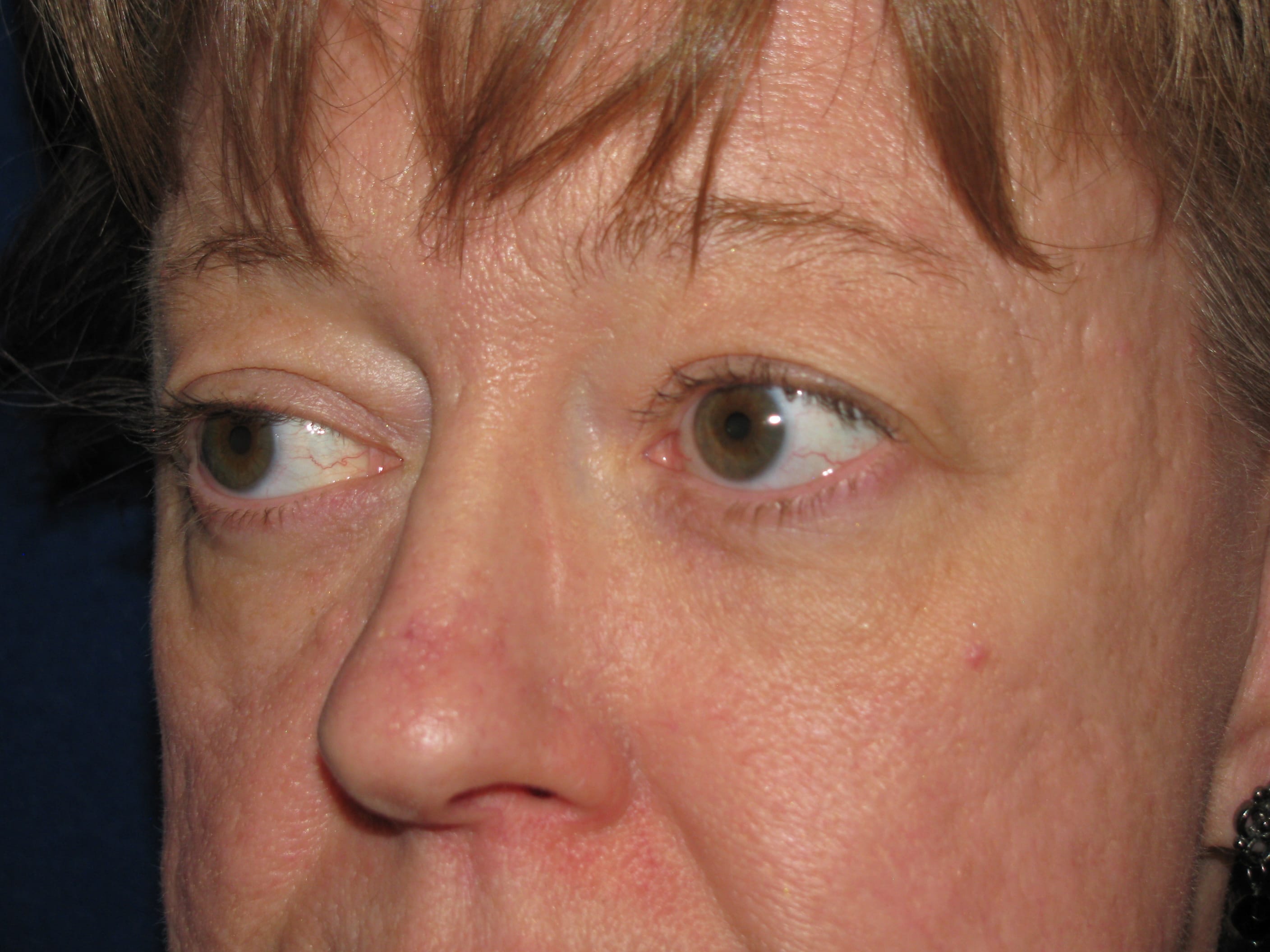 Upper Blepharoplasty Before and After | LV Plastic Surgery