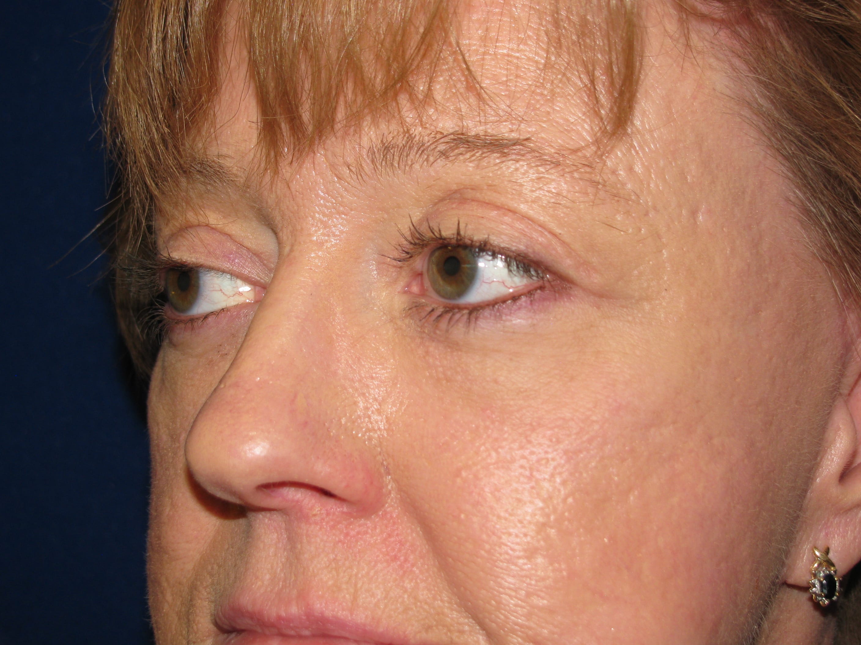 Upper Blepharoplasty Before and After | LV Plastic Surgery