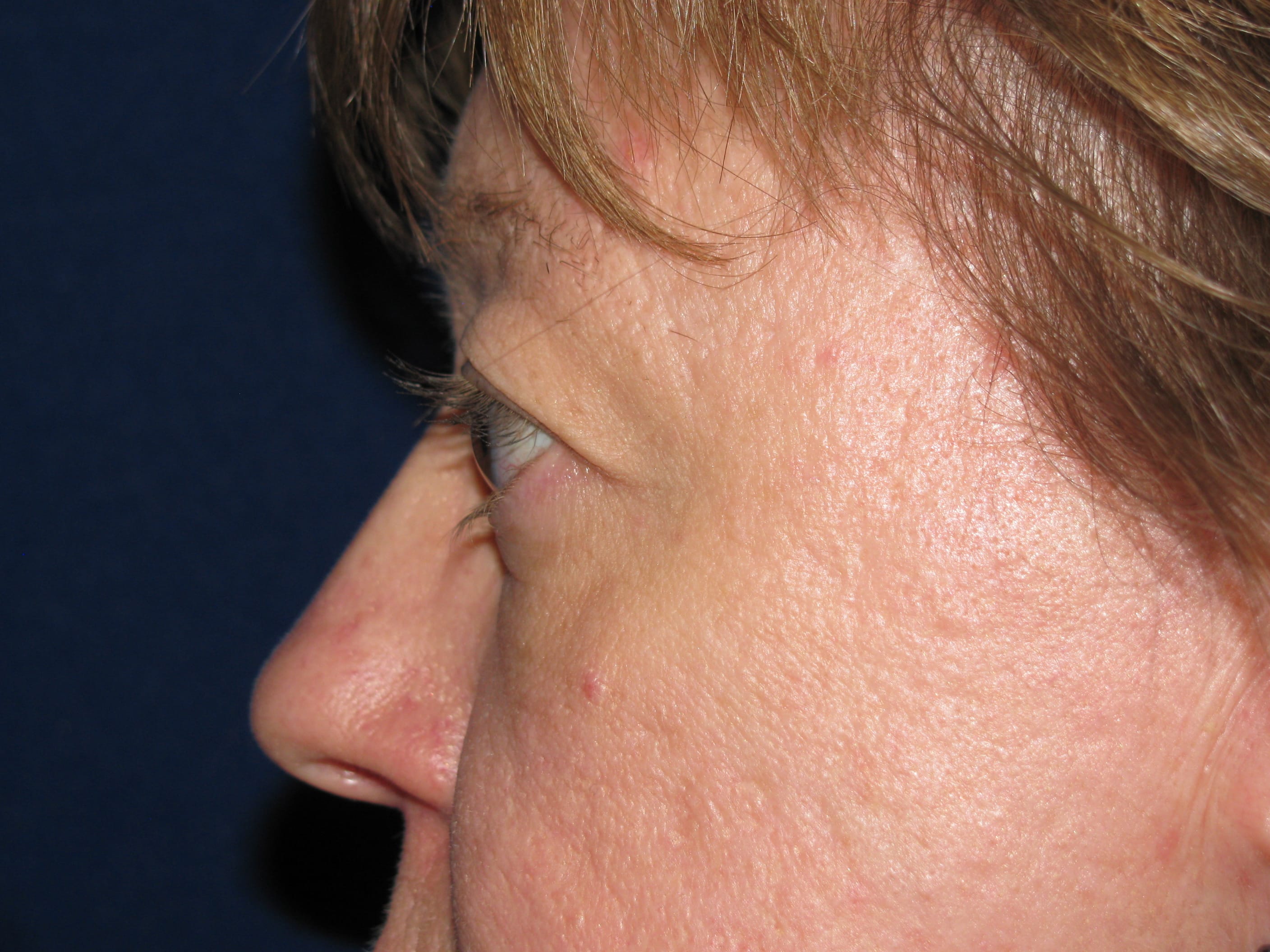 Upper Blepharoplasty Before and After | LV Plastic Surgery