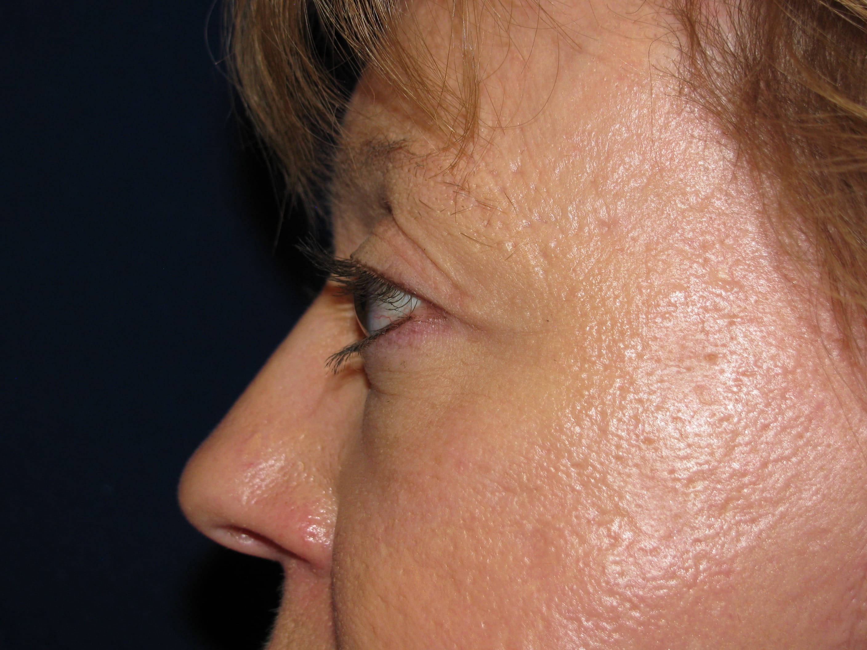 Upper Blepharoplasty Before and After | LV Plastic Surgery