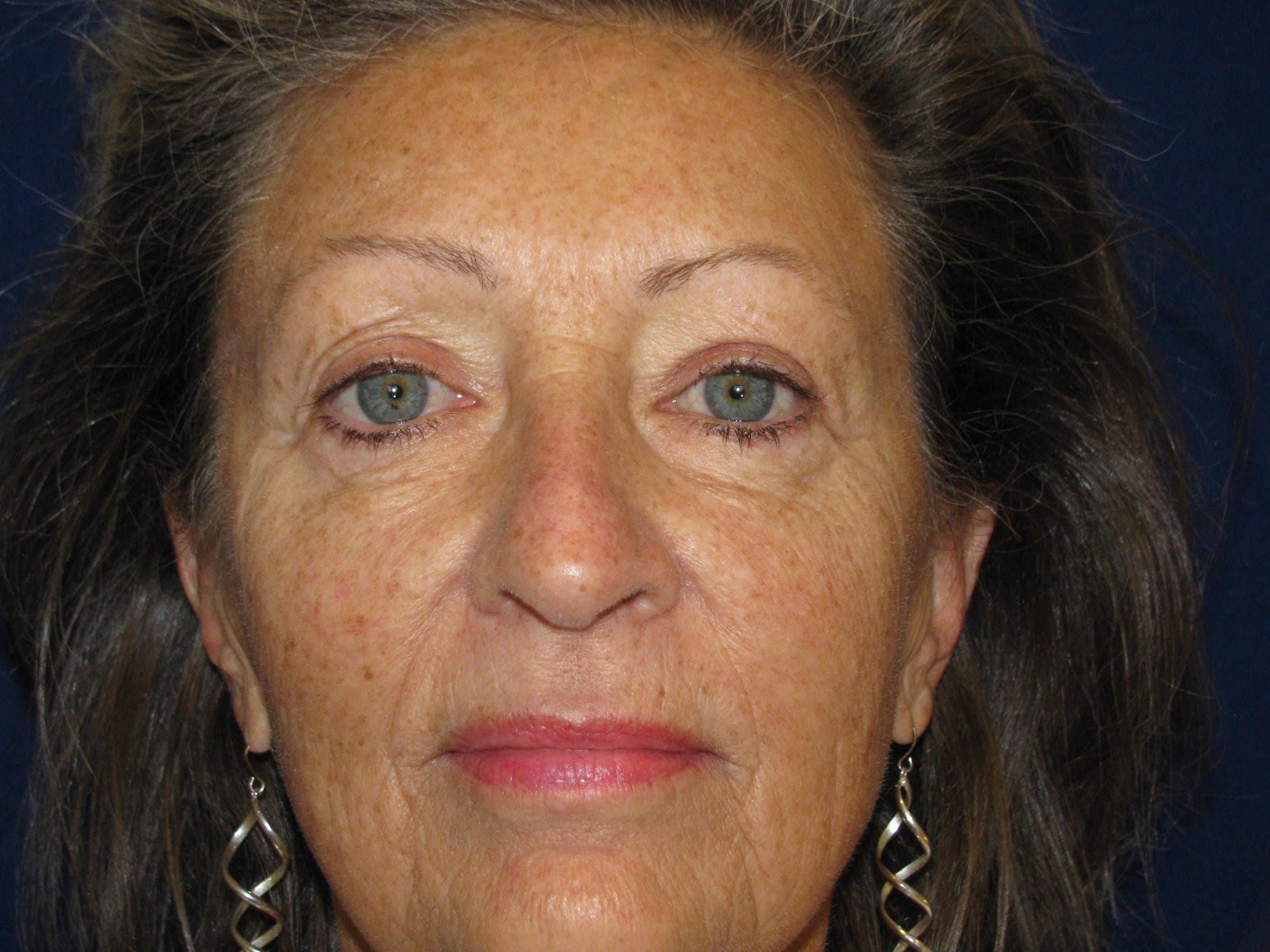 Upper Blepharoplasty Before and After | LV Plastic Surgery