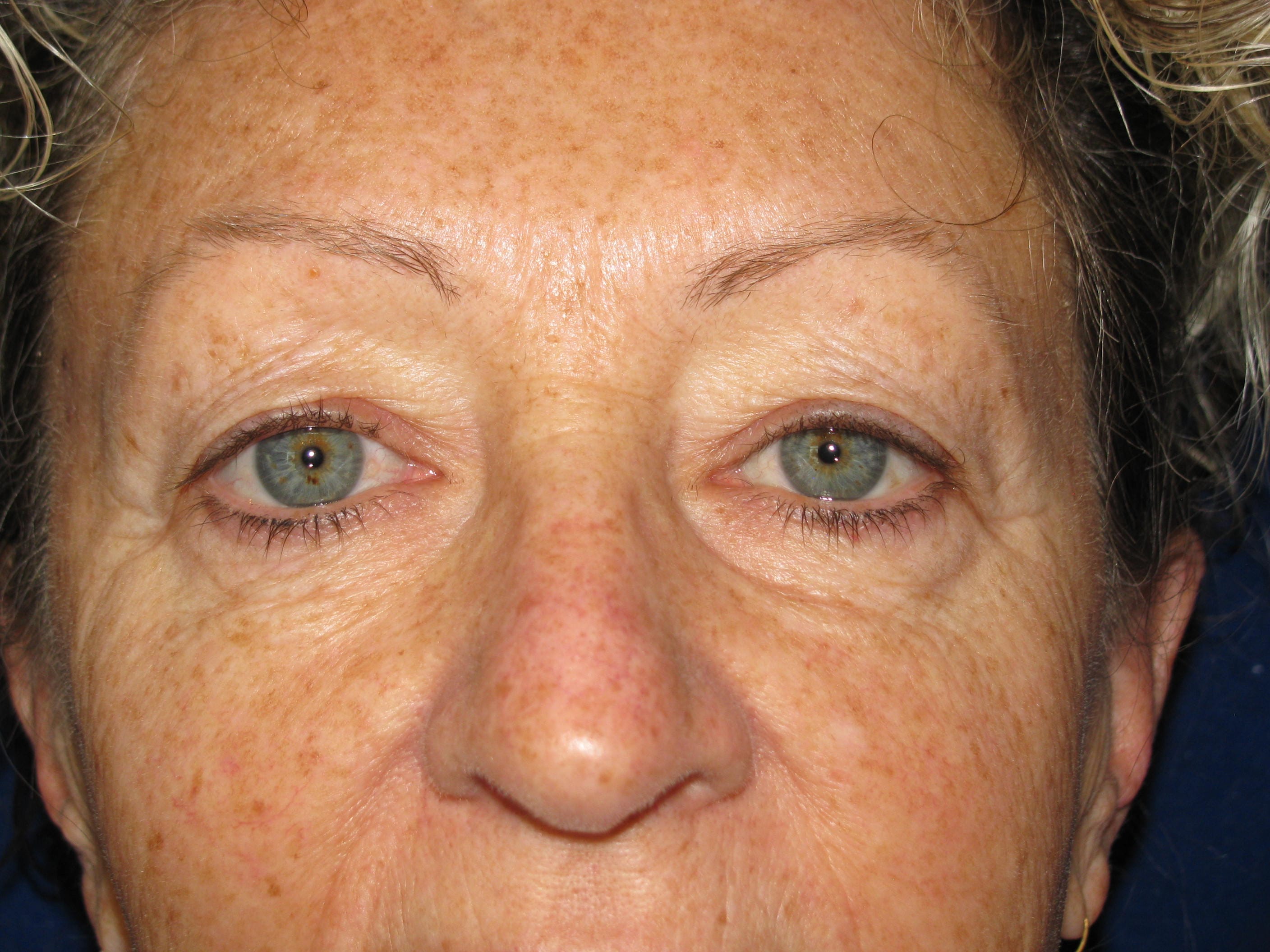 Upper Blepharoplasty Before and After | LV Plastic Surgery