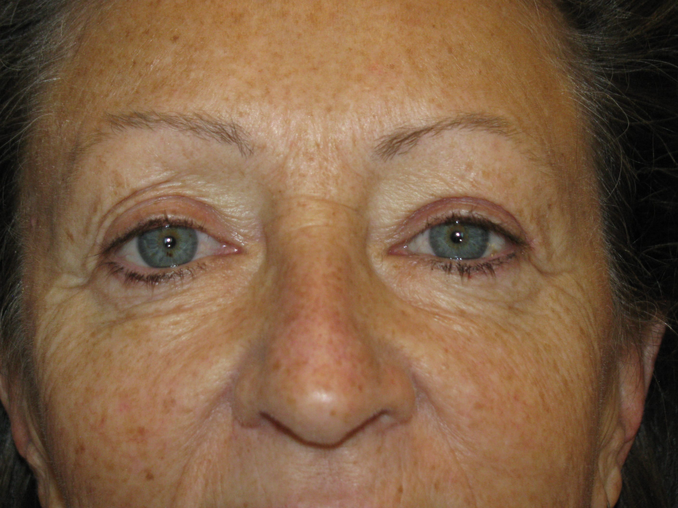 Upper Blepharoplasty Before and After | LV Plastic Surgery