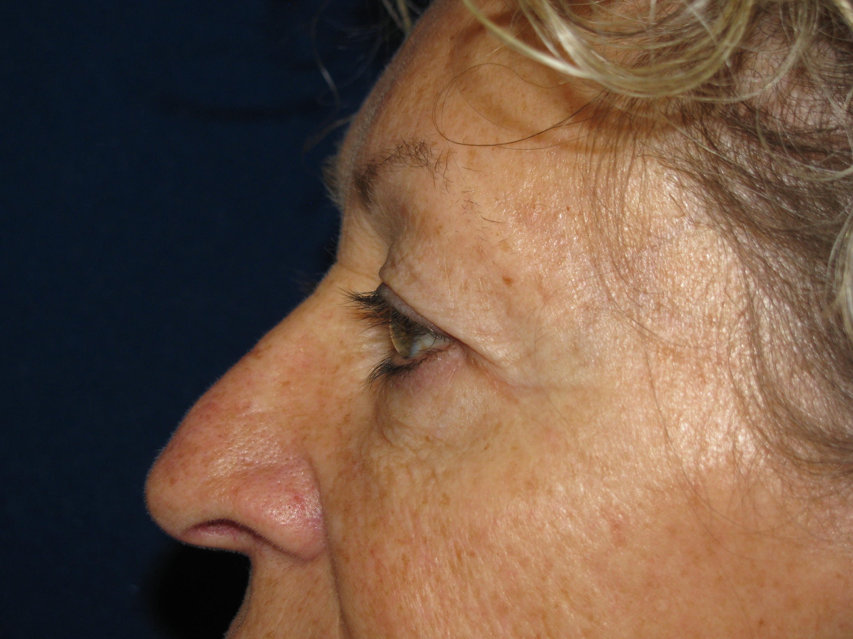 Upper Blepharoplasty Before and After | LV Plastic Surgery