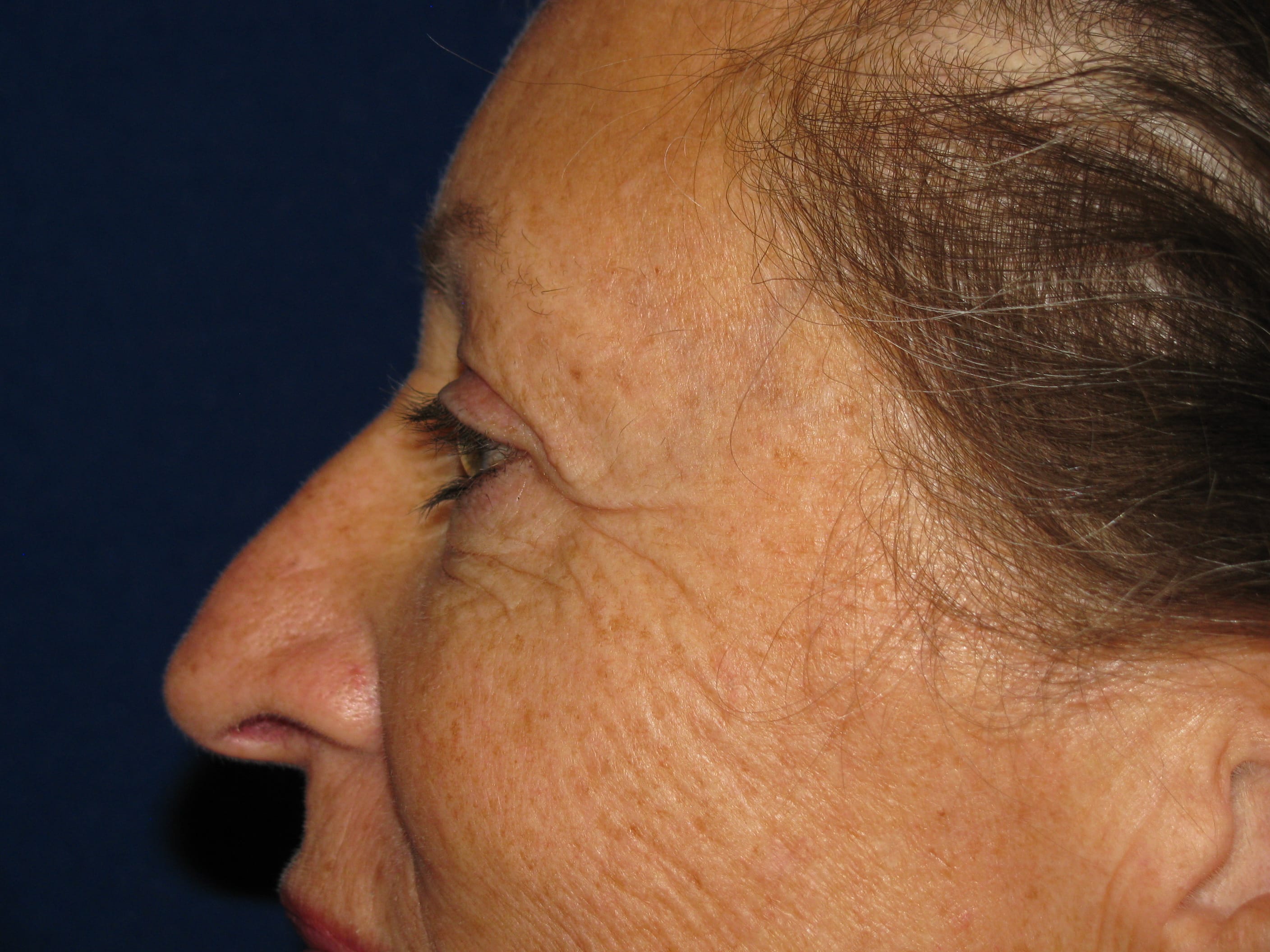 Upper Blepharoplasty Before and After | LV Plastic Surgery