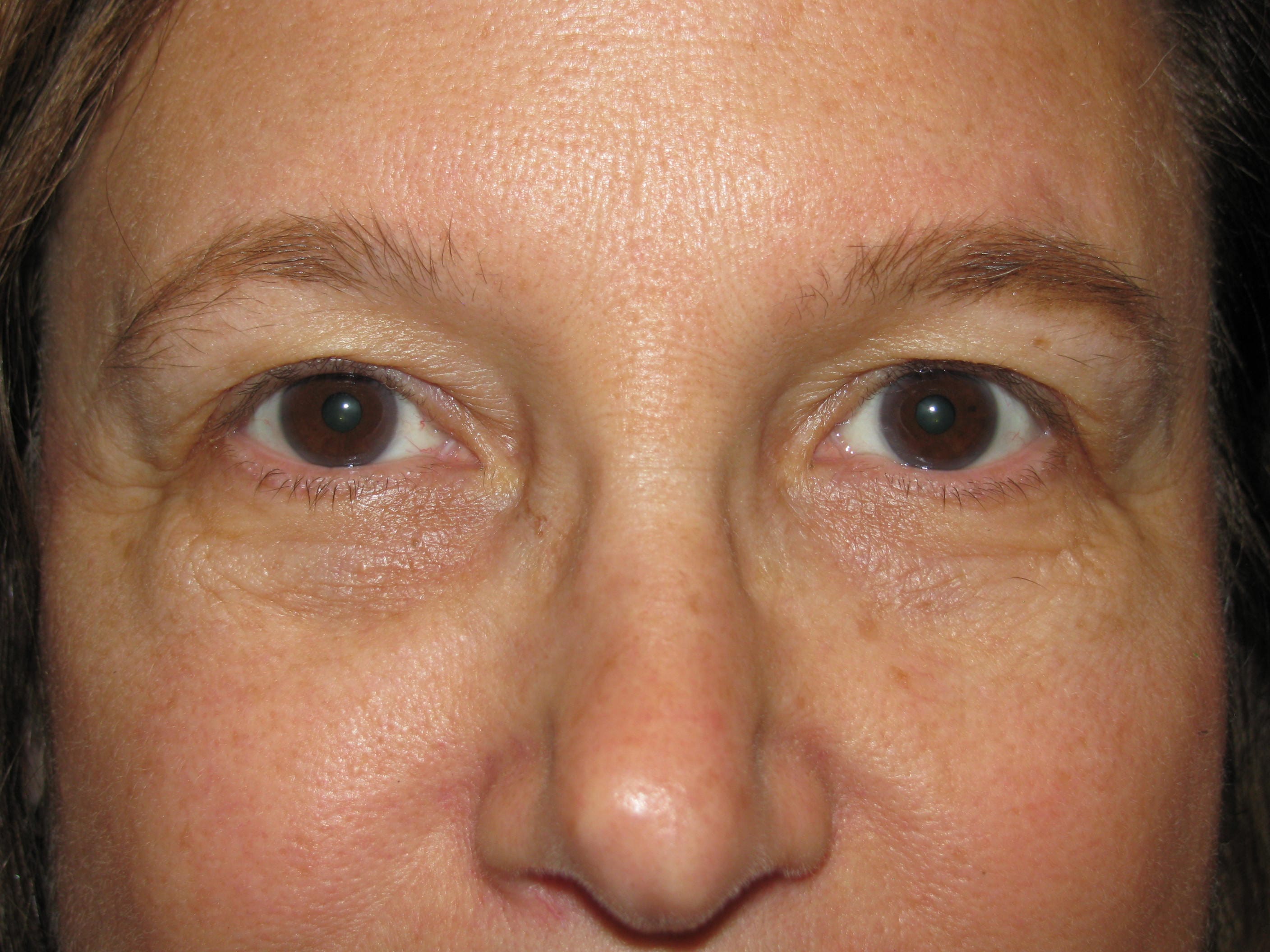 Upper Blepharoplasty Before and After | LV Plastic Surgery