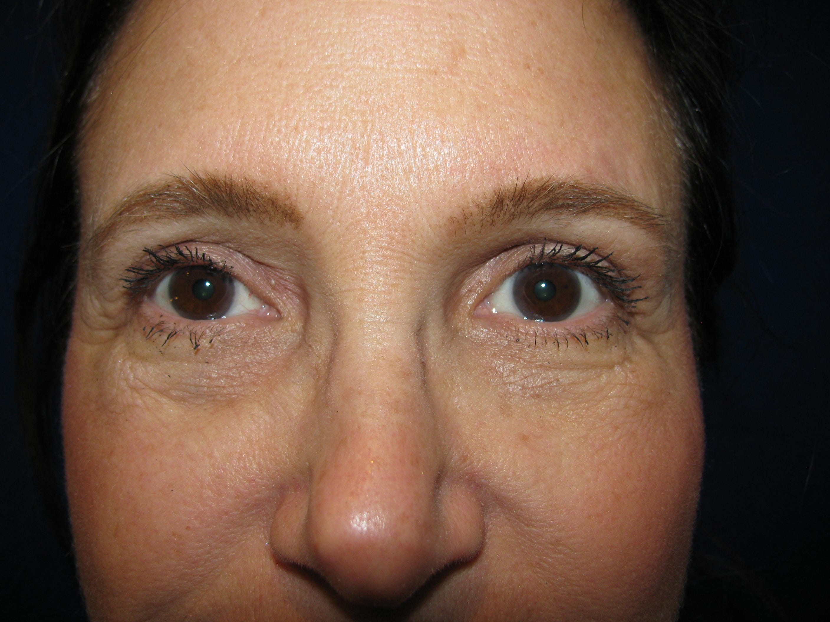 Upper Blepharoplasty Before and After | LV Plastic Surgery