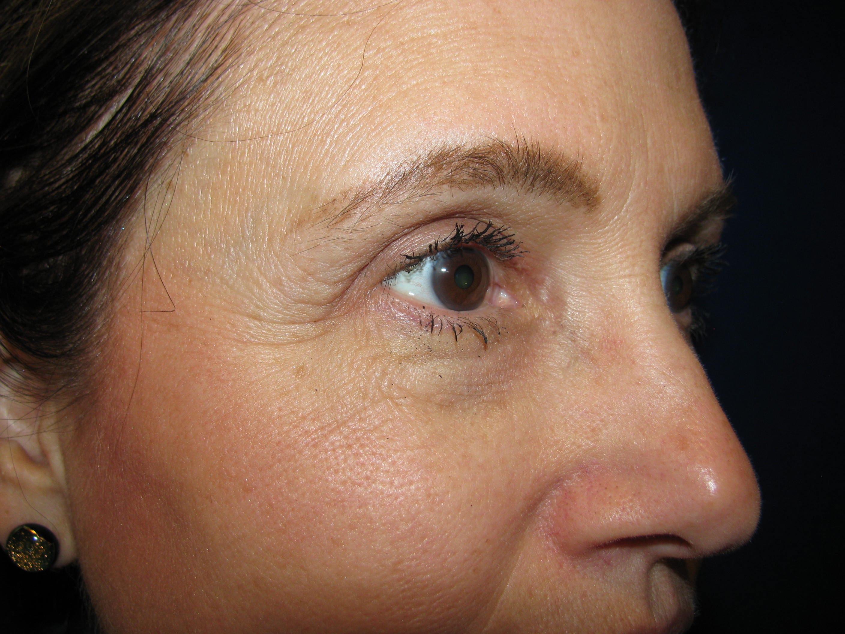 Upper Blepharoplasty Before and After | LV Plastic Surgery