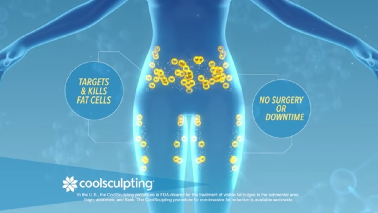 CoolSculpting Video