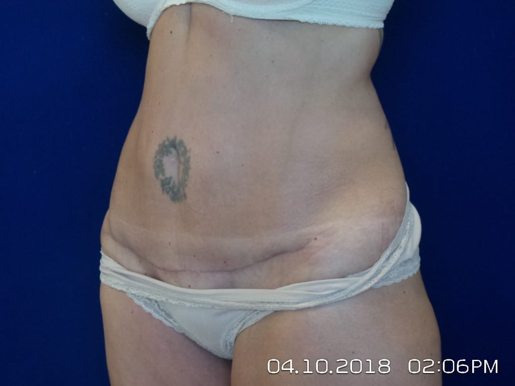 Reverse Upper Modified Lower Abdominoplasty